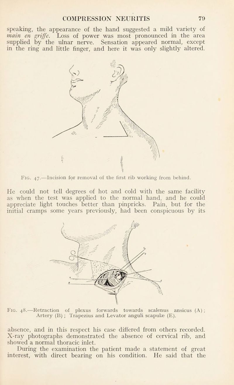 speaking, the appearance of the hand suggested a mild variety of main en griffe. Loss of power was most pronounced in the area supplied by the ulnar nerve. Sensation appeared normal, except in the ring and little finger, and here it was only slightly altered. Fig. 47.—Incision for removal of the first rib working from behind. He could not tell degrees of hot and cold with the same facility as when the test was applied to the normal hand, and he could appreciate light touches better than pinpricks. Pain, but for the initial cramps some years previously, had been conspicuous by its Fig. 48.—Retraction of plexus forwards towards scalenus ansicus (A) ; Artery (B) ; Trapezius and Levator anguli scapulae (E). absence, and in this respect his case differed from others recorded. X-ray photographs demonstrated the absence of cervical rib, and showed a normal thoracic inlet. During the examination the patient made a statement of great interest, with direct bearing on his condition. He said that the