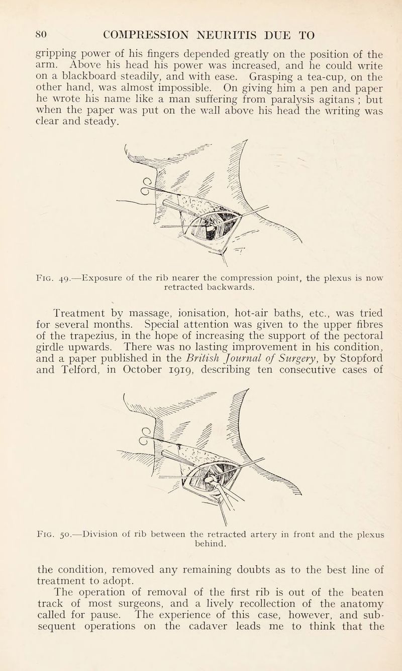 gripping power of his fingers depended greatly on the position of the arm. Above his head his power was increased, and he could write on a blackboard steadily, and with ease. Grasping a tea-cup, on the other hand, was almost impossible. On giving him a pen and paper he wrote his name like a man suffering from paralysis agitans ; but when the paper was put on the wall above his head the writing was clear and steady. Fig. 49.—Exposure of the rib nearer the compression point, the plexus is now retracted backwards. Treatment by massage, ionisation, hot-air baths, etc., was tried for several months. Special attention was given to the upper fibres of the trapezius, in the hope of increasing the support of the pectoral girdle upwards. There was no lasting improvement in his condition, and a paper published in the British Journal of Surgery, by Stopford and Telford, in October 1919, describing ten consecutive cases of Fig. 50.—Division of rib between the retracted artery in front and the plexus behind. the condition, removed any remaining doubts as to the best line of treatment to adopt. The operation of removal of the first rib is out of the beaten track of most surgeons, and a lively recollection of the anatomy called for pause. The experience of this case, however, and sub¬ sequent operations on the cadaver leads me to think that the