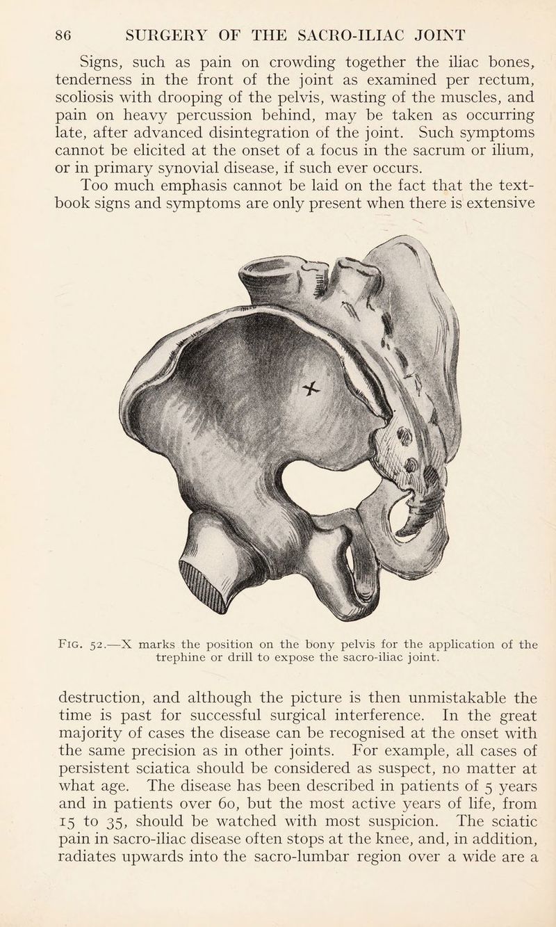 Signs, such as pain on crowding together the iliac bones, tenderness in the front of the joint as examined per rectum, scoliosis with drooping of the pelvis, wasting of the muscles, and pain on heavy percussion behind, may be taken as occurring late, after advanced disintegration of the joint. Such symptoms cannot be elicited at the onset of a focus in the sacrum or ilium, or in primary synovial disease, if such ever occurs. Too much emphasis cannot be laid on the fact that the text¬ book signs and symptoms are only present when there is extensive Fig. 52.—X marks the position on the bony pelvis for the application of the trephine or drill to expose the sacro-iliac joint. destruction, and although the picture is then unmistakable the time is past for successful surgical interference. In the great majority of cases the disease can be recognised at the onset with the same precision as in other joints. For example, all cases of persistent sciatica should be considered as suspect, no matter at what age. The disease has been described in patients of 5 years and in patients over 60, but the most active years of life, from 15 f° 35> should be watched with most suspicion. The sciatic pain in sacro-iliac disease often stops at the knee, and, in addition, radiates upwards into the sacro-lumbar region over a wide are a