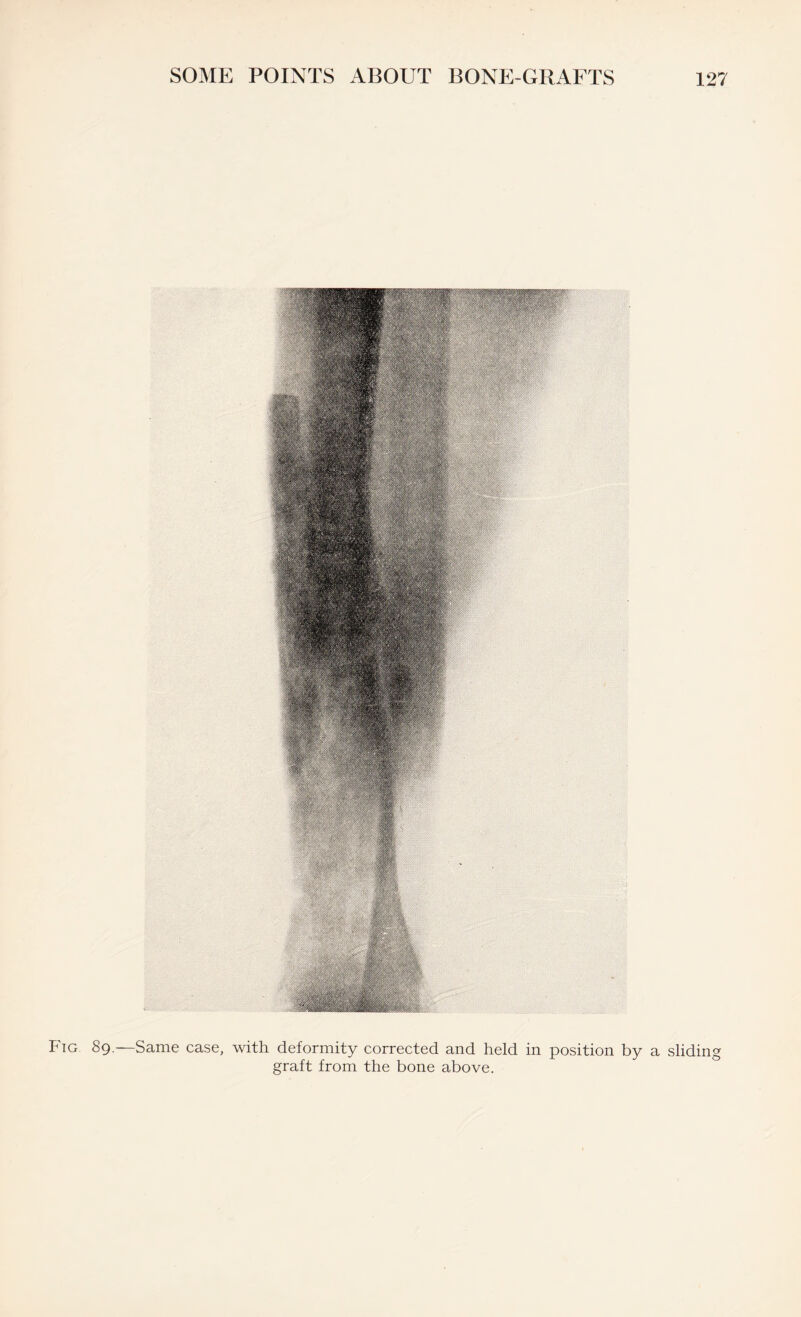 Fig 89.—Same case, with deformity corrected and held in position by a sliding graft from the bone above.