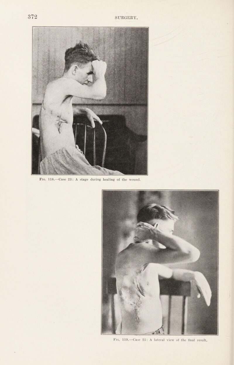 Fig. 119.—Case 23: A lateral view of the final result