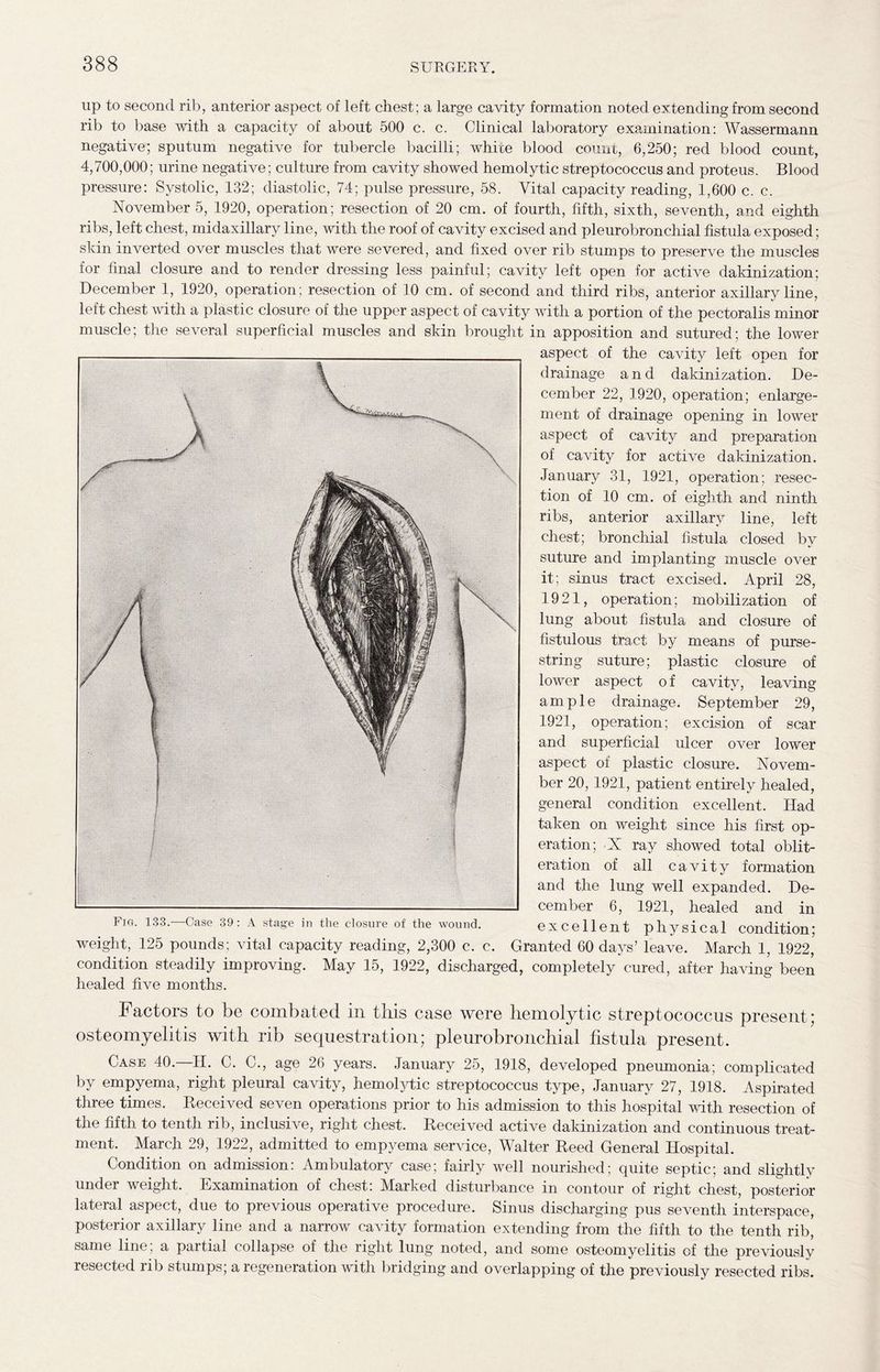 up to second rib, anterior aspect of left chest; a large cavity formation noted extending from second rib to base with a capacity of about 500 c. c. Clinical laboratory examination: Wassermann negative; sputum negative for tubercle bacilli; white blood count, 6,250; red blood count, 4,700,000; urine negative; culture from cavity showed hemolytic streptococcus and proteus. Blood pressure: Systolic, 132; diastolic, 74; pulse pressure, 58. Vital capacity reading, 1,600 c. c. November 5, 1920, operation; resection of 20 cm. of fourth, fifth, sixth, seventh, and eighth ribs, left chest, midaxillary line, with the roof of cavity excised and pleurobronchial fistula exposed; skin inverted over muscles that were severed, and fixed over rib stumps to preserve the muscles for final closure and to render dressing less painful; cavity left open for active dakinization; December 1, 1920, operation; resection of 10 cm. of second and third ribs, anterior axillary line, left chest with a plastic closure of the upper aspect of cavity with a portion of the pectoralis minor muscle; the several superficial muscles and skin brought in apposition and sutured; the lower aspect of the cavity left open for drainage and dakinization. De¬ cember 22, 1920, operation; enlarge¬ ment of drainage opening in lower aspect of cavity and preparation of cavity for active dakinization. January 31, 1921, operation; resec¬ tion of 10 cm. of eighth and ninth ribs, anterior axillary line, left chest; bronchial fistula closed by suture and implanting muscle over it; sinus tract excised. April 28, 1921, operation; mobilization of lung about fistula and closure of fistulous tract by means of purse¬ string suture; plastic closure of lower aspect of cavity, leaving ample drainage. September 29, 1921, operation; excision of scar and superficial ulcer over lower aspect of plastic closure. Novem¬ ber 20, 1921, patient entirely healed, general condition excellent. Had taken on weight since his first op¬ eration; N ray showed total oblit¬ eration of all cavity formation and the lung well expanded. De¬ cember 6, 1921, healed and in excell ent physical condition; weight, 125 pounds; vital capacity reading, 2,300 c. c. Granted 60 days’ leave. March 1, 1922, condition steadily improving. May 15, 1922, discharged, completely cured, after having been healed five months. osteomyelitis with rib sequestration; pleurobronchial fistula present. Case 40.—11. C. C., age 26 years. January 25, 1918, developed pneumonia; complicated by empyema, right pleural cavity, hemofihic streptococcus type, January 27, 1918. Aspirated three times. Received seven operations prior to his admission to this hospital with resection of the fifth to tenth rib, inclusive, right chest. Received active dakinization and continuous treat¬ ment. March 29, 1922, admitted to empyema service, Walter Reed General Hospital. Condition on admission: Ambulatory case; fairly well nourished; quite septic; and slightly under weight. Examination of chest: Marked disturbance in contour of right chest, posterior lateral aspect, due to previous operative procedure. Sinus discharging pus seventh interspace, posterior axillary line and a narrow cavity formation extending from the fifth to the tenth rib, same line; a partial collapse of the right lung noted, and some osteomyelitis of the previously resected rib stumps; a regeneration with bridging and overlapping of the previously resected ribs. Ftg. 133.—Case 39: A stage in the closure of the wound.