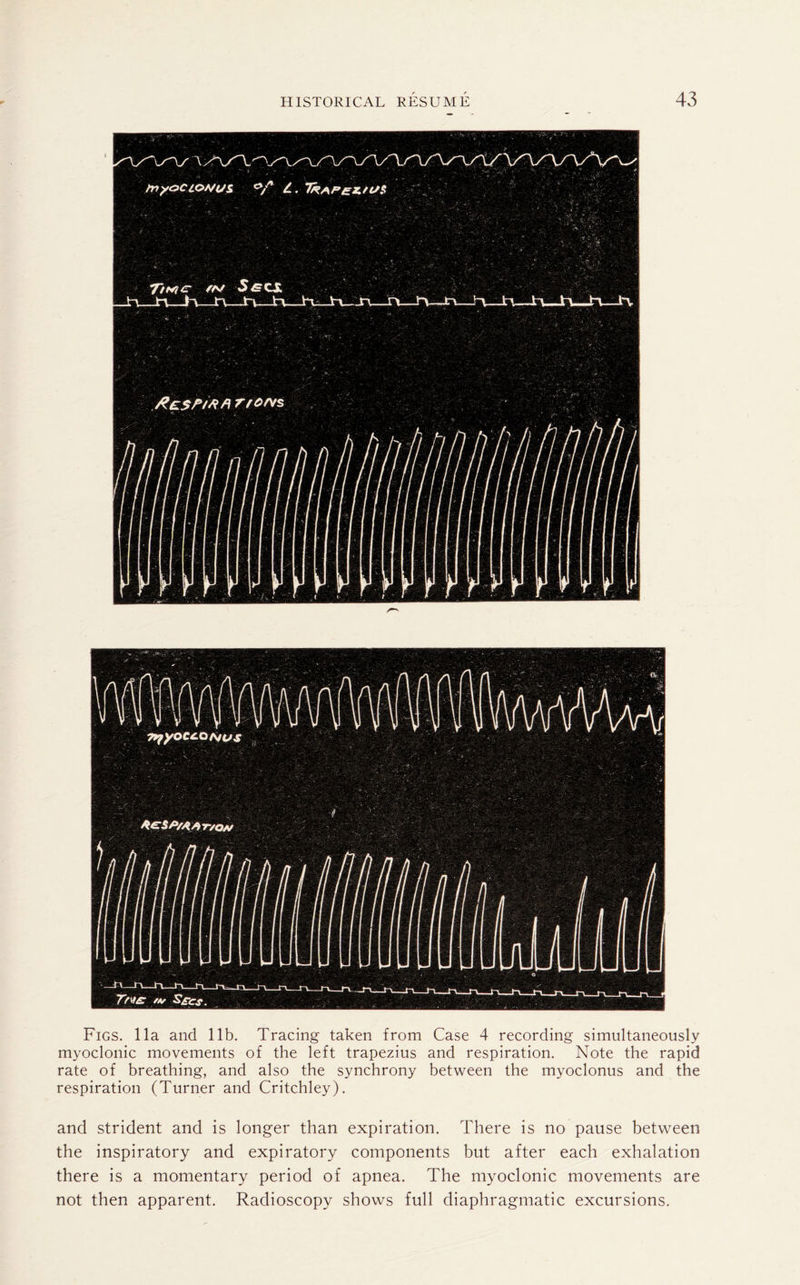 Figs. 11a and lib. Tracing taken from Case 4 recording simultaneously myoclonic movements of the left trapezius and respiration. Note the rapid rate of breathing, and also the synchrony between the myoclonus and the respiration (Turner and Critchley). and strident and is longer than expiration. There is no pause between the inspiratory and expiratory components but after each exhalation there is a momentary period of apnea. The myoclonic movements are not then apparent. Radioscopy shows full diaphragmatic excursions.