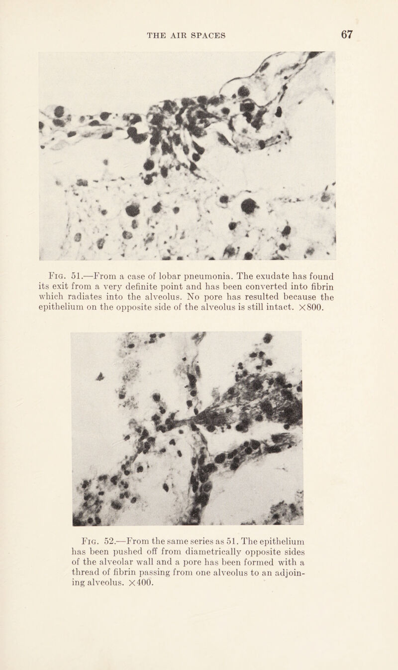 Fig. 51.—From a case of lobar pneumonia. The exudate has found its exit from a very definite point and has been converted into fibrin which radiates into the alveolus. No pore has resulted because the epithelium on the opposite side of the alveolus is still intact. X800. Fig. 52.—From the same series as 51. The epithelium has been pushed off from diametrically opposite sides of the alveolar wall and a pore has been formed with a thread of fibrin passing from one alveolus to an adjoin¬ ing alveolus. X400.