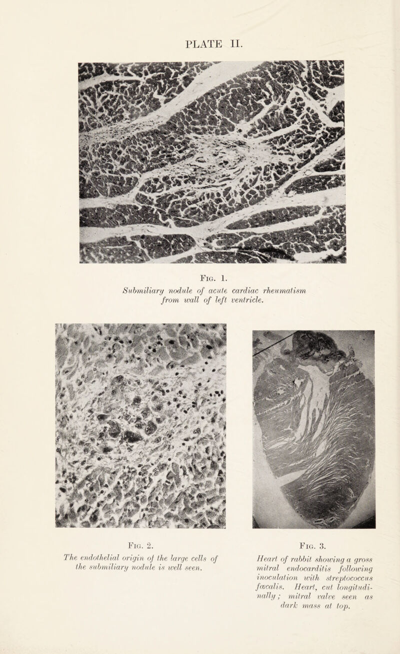 Fig. 1. Submiliary nodule of acute cardiac rheumatism from wall of left ventricle. Fig. 2. The endothelial origin of the large cells of the submiliary nodule is well seen. Fig. 3. Heart of rabbit showing a gross mitral endocarditis following inoculation with streptococcus fcBcalis. Heart, cut longitudi¬ nally ; mitral valve seen as dark mass at top.