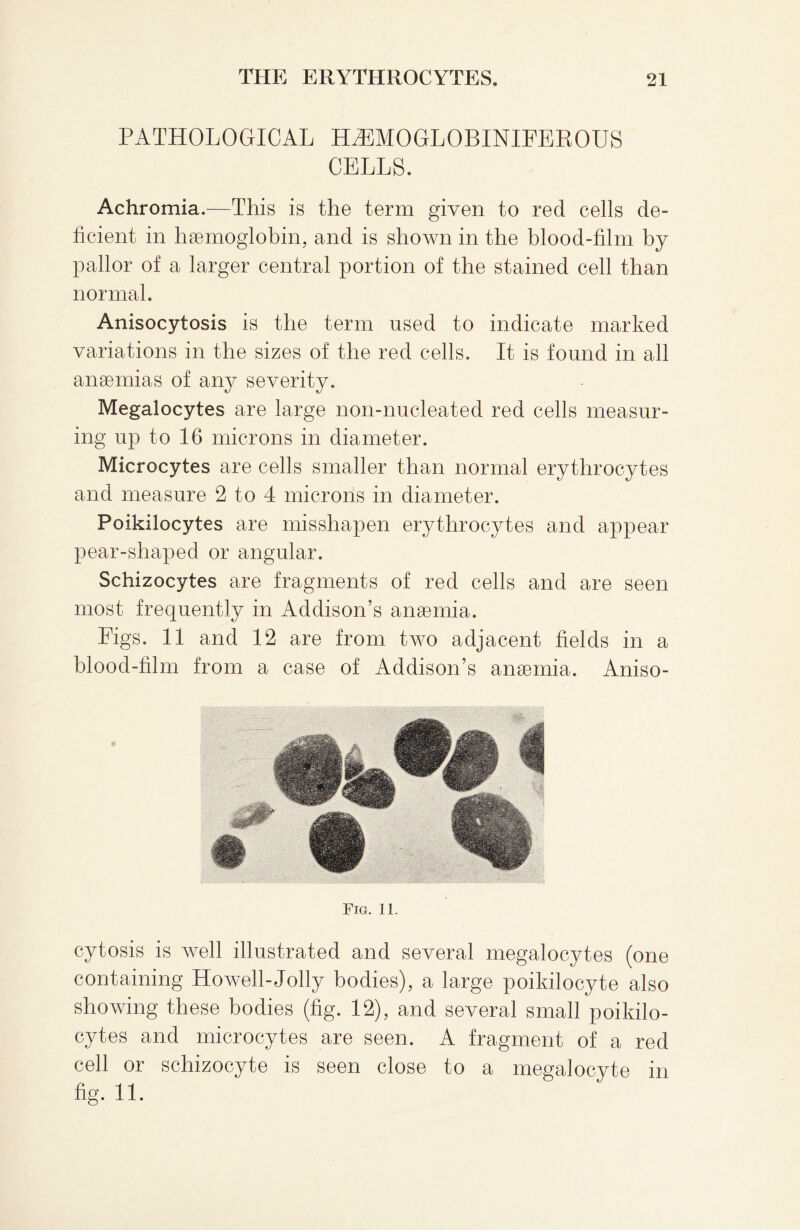 PATHOLOGICAL HHMOGLOBINIFEROUS CELLS. Achromia.—This is the term given to red cells de¬ ficient in haemoglobin, and is shown in the blood-film by pallor of a larger central portion of the stained cell than normal. Anisocytosis is the term used to indicate marked variations in the sizes of the red cells. It is found in all anaemias of any severity. Megalocytes are large non-nucleated red cells measur¬ ing up to 16 microns in diameter. Microcytes are cells smaller than normal erythrocytes and measure 2 to 4 microns in diameter. Poikilocytes are misshapen erythrocytes and appear pear-shaped or angular. Schizocytes are fragments of red cells and are seen most frequently in Addison’s anaemia. Figs. 11 and 12 are from two adjacent fields in a blood-film from a case of Addison’s anaemia. Aniso- Fig. 11. cytosis is well illustrated and several megalocytes (one containing Howell-Jolly bodies), a large poikilocyte also showing these bodies (fig. 12), and several small poikilo¬ cytes and microcytes are seen. A fragment of a red cell or schizocyte is seen close to a megalocyte in fig. 11.