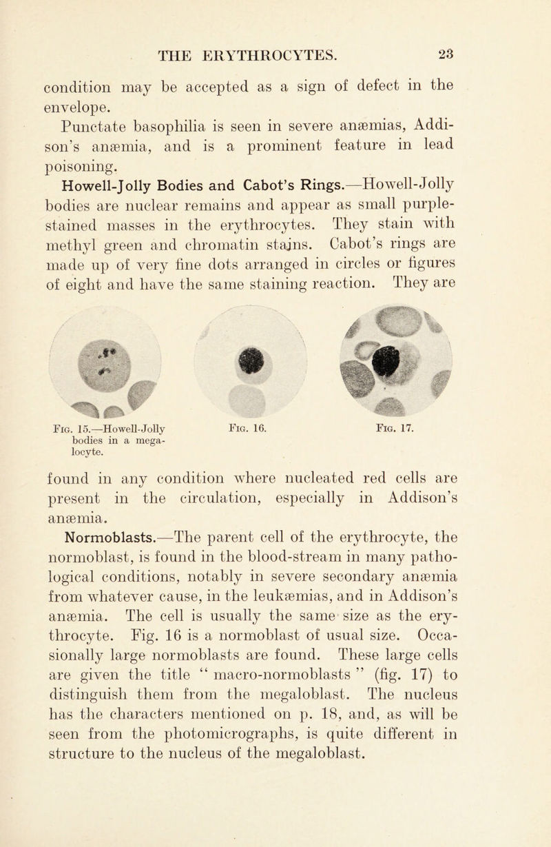 condition may be accepted as a sign of defect in the envelope. Punctate basophilia is seen in severe anaemias, Addi¬ son’s anaemia, and is a prominent feature in lead poisoning. Howell-Jolly Bodies and Cabot’s Rings.—Howell-Jolly bodies are nuclear remains and appear as small purple- stained masses in the erythrocytes. They stain with methyl green and chromatin stains. Cabot’s rings are made up of very fine dots arranged in circles or figures of eight and have the same staining reaction. They are Fig. 15.—Howell-Jolly Fig. 16. Fig. 17. bodies in a mega- loeyte. found in any condition where nucleated red cells are present in the circulation, especially in Addison’s anaemia. Normoblasts.—The parent cell of the erythrocyte, the normoblast, is found in the blood-stream in many patho¬ logical conditions, notably in severe secondary anaemia from whatever cause, in the leukaemias, and in Addison’s anaemia. The cell is usually the same size as the ery¬ throcyte. Fig. 16 is a normoblast of usual size. Occa¬ sionally large normoblasts are found. These large cells are given the title “ macro-normoblasts ” (fig. 17) to distinguish them from the megaloblast. The nucleus has the characters mentioned on p. 18, and, as will be seen from the photomicrographs, is quite different in structure to the nucleus of the megaloblast.