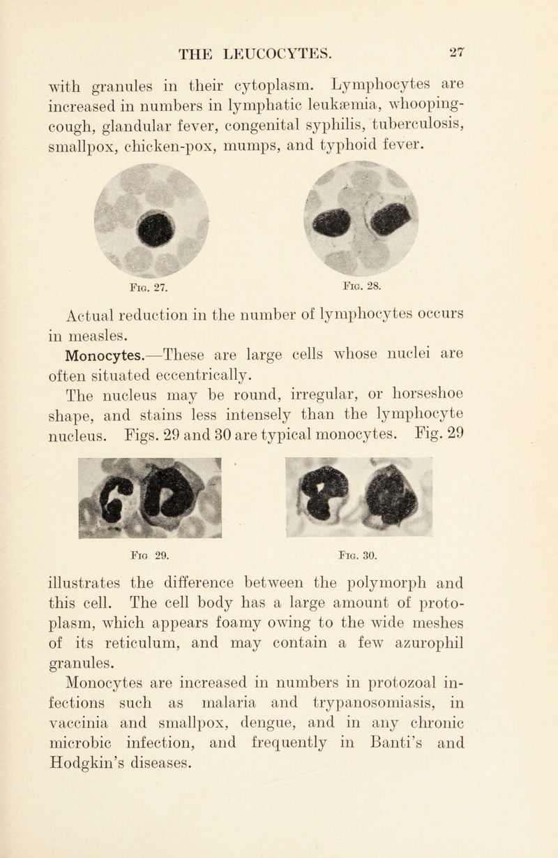 with granules in their cytoplasm. Lymphocytes are increased in numbers in lymphatic leukaemia, whooping- cough, glandular fever, congenital syphilis, tuberculosis, smallpox, chicken-pox, mumps, and typhoid fever. Fig. 27. Fig. 28. Actual reduction in the number of lymphocytes occurs in measles. Monocytes.—These are large cells whose nuclei are often situated eccentrically. The nucleus may be round, irregular, or horseshoe shape, and stains less intensely than the lymphocyte nucleus. Figs. 29 and 80 are typical monocytes. Fig. 29 Fig 29. Fig. 30. illustrates the difference between the polymorph and this cell. The cell body has a large amount of proto¬ plasm, which appears foamy owing to the wide meshes of its reticulum, and may contain a few azurophil granules. Monocytes are increased in numbers in protozoal in¬ fections such as malaria and trypanosomiasis, in vaccinia and smallpox, dengue, and in any chronic microbic infection, and frequently in Banti’s and Hodgkin’s diseases.
