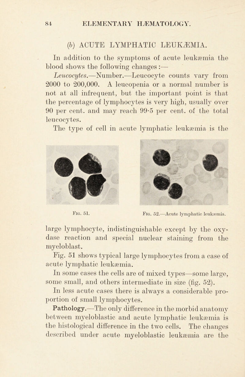 (b) ACUTE LYMPHATIC LEUKAEMIA. In addition to the symptoms of acute leukaemia the blood shows the following changes :— Leucocytes.—Number.—Leucocyte counts vary from 2000 to 200,000. A leucopenia or a normal number is not at all infrequent, but the important point is that the percentage of lymphocytes is very high, usually over 90 per cent, and may reach 99-5 per cent, of the total leucocytes. The type of cell in acute lymphatic leukaemia is the Fig. 51. Fig. 52.-—Acute lymphatic leukaemia. large lymphocyte, indistinguishable except by the oxy¬ dase reaction and special nuclear staining from the myeloblast. Eig. 51 shows typical large lymphocytes from a case of acute lymphatic leukaemia. In some cases the cells are of mixed types—some large, some small, and others intermediate in size (fig. 52). In less acute cases there is always a considerable pro¬ portion of small lymphocytes. Pathology.—The only difference in the morbid anatomy between myeloblastic and acute lymphatic leukaemia is the histological difference in the two cells. The changes described under acute myeloblastic leukaemia are the