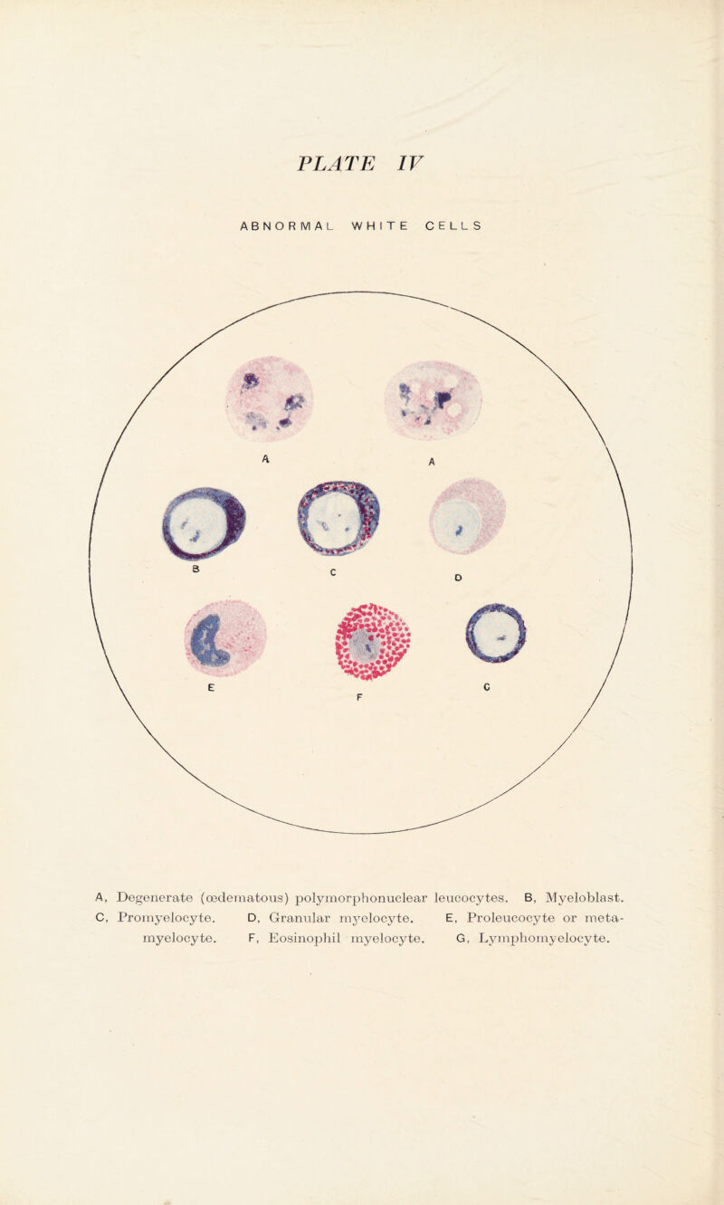 ABNORMAL WHITE CELLS A, Degenerate (oeclematous) polymorphonuclear leucocytes. B, Myeloblast. C, Promyelocyte. D, Granular myelocyte. E, Proleucocyte or meta¬ myelocyte. F, Eosinophil myelocyte. G, Lymphomyelocyte.