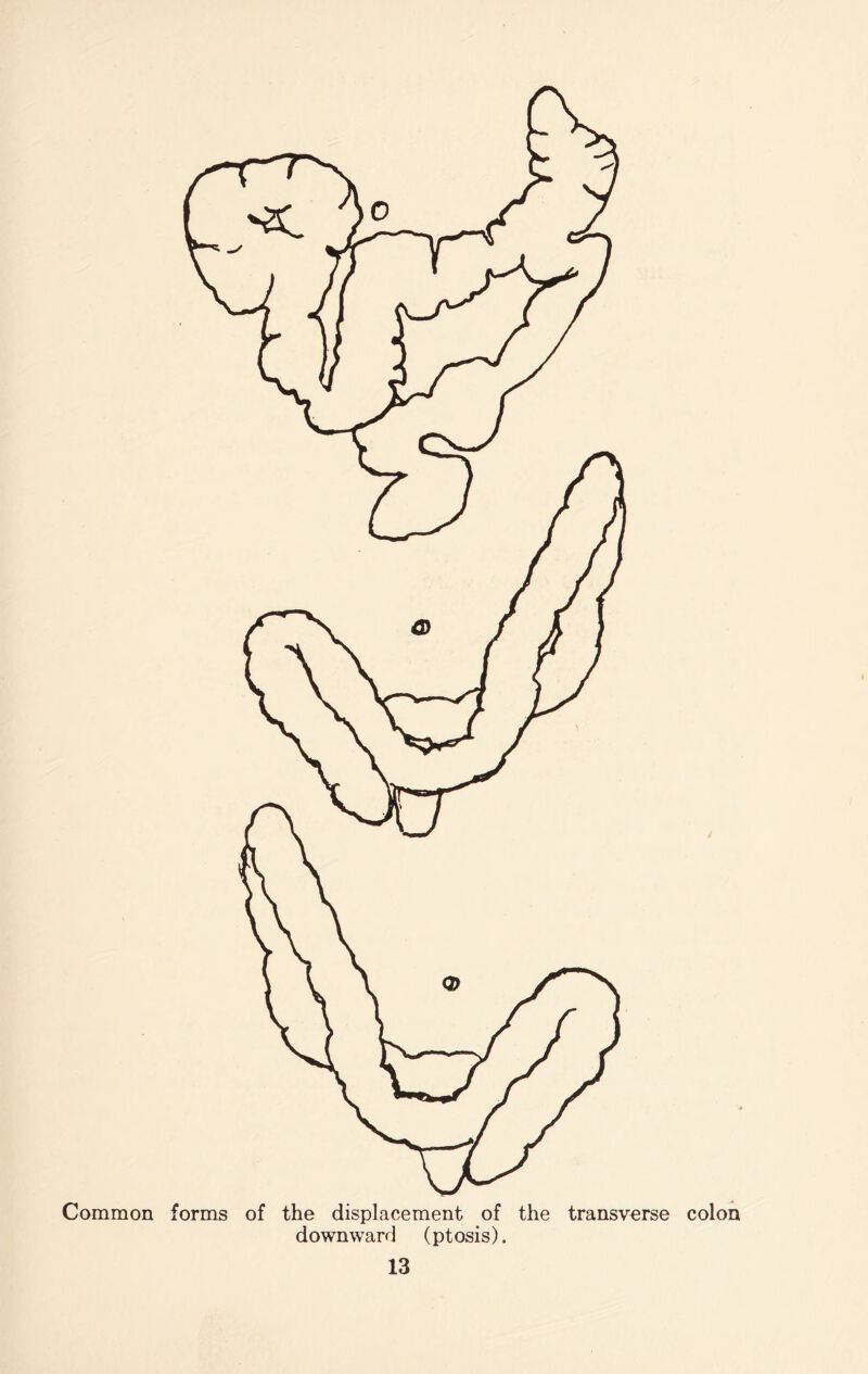 orms the displacement of the transverse colon downward (ptosis).
