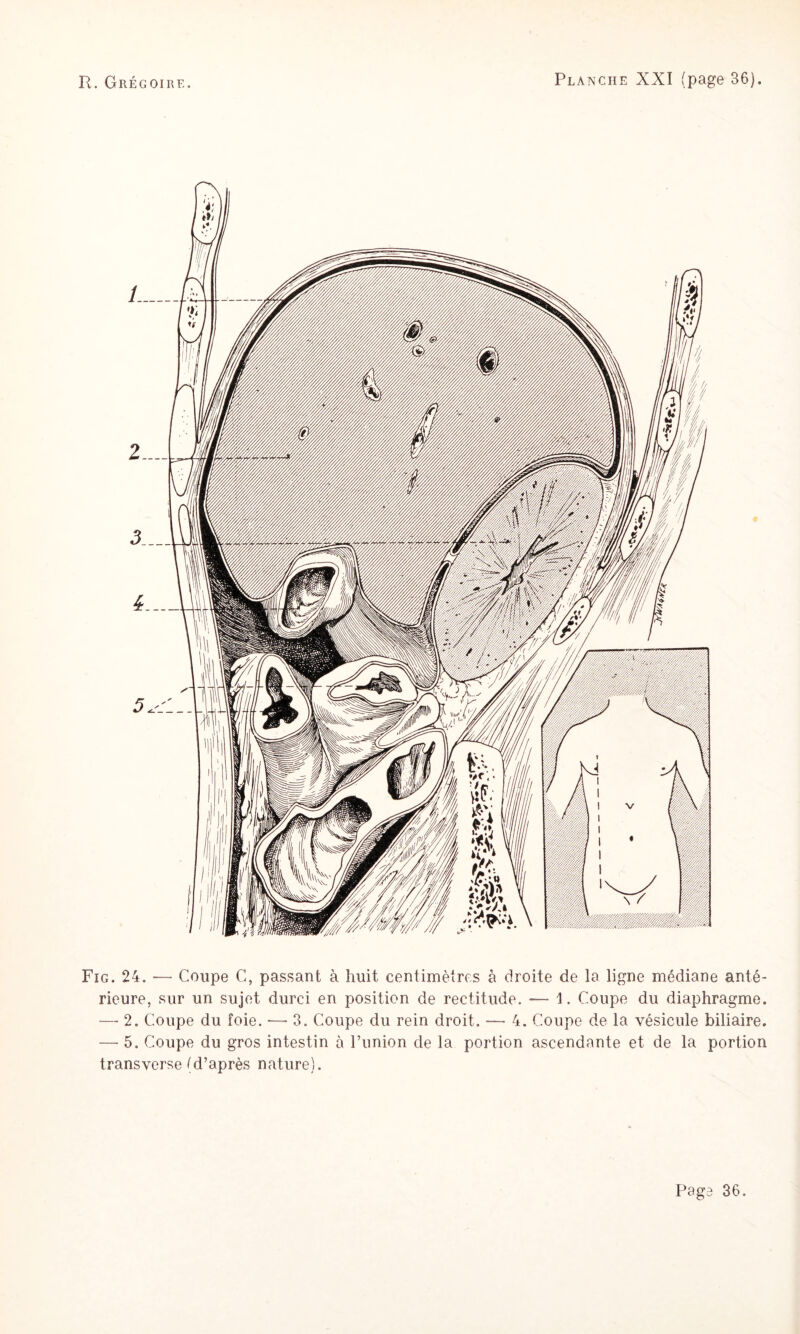 Fig. 24. — Coupe C, passant à huit centimètres à droite de la ligne médiane anté¬ rieure, sur un sujet durci en position de rectitude. — 1. Coupe du diaphragme. — 2. Coupe du foie. — 8. Coupe du rein droit. — 4. Coupe de la vésicule biliaire. — 5. Coupe du gros intestin à l’union de la portion ascendante et de la portion transverse (d’après nature).