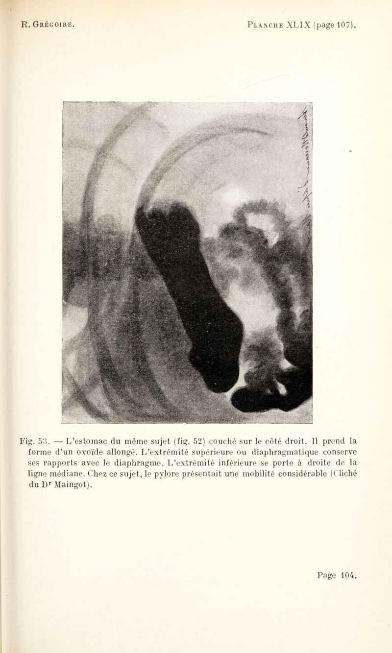 Fig. 5o. — L’estomac du même sujet (fig. 52) couché sur le côté droit. Il prend la forme d’un ovoïde allongé. L’extrémité supérieure ou diaphragmatique conserve ses rapports avec le diaphragme. L’extrémité inférieure se porte à droite de la ligne médiane. Chez ce sujet, le pylore présentait une mobilité considérable (Cliché du D’’ Maingot).