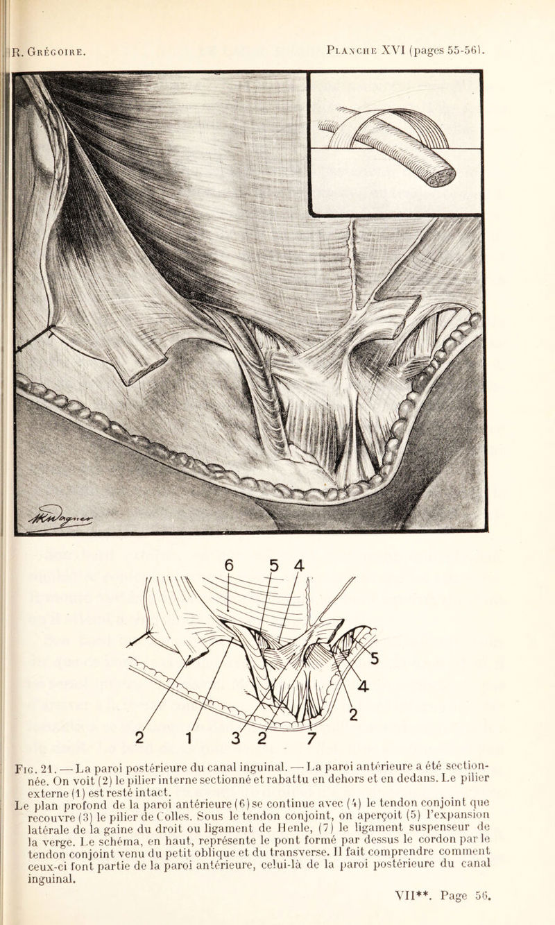 PiG 21. — La paroi postérieure du canal inguinal. — La paroi antérieure a été section¬ née. Ôn voit (2) le pilier interne sectionné et rabattu en dehors et en dedans. Le pilier externe (1) est resté intact. ^ ^ : Le plan profond de la paroi antérieure (6)se continue avec (4) le tendon conjoint que i recouvre (3) le pilier de Colles. Sous le tendon conjoint, on aperçoit (5) l’expansion latérale de la gaine du droit ou ligament de Henle, (7) le ligament suspenseur de la verge. Le schéma, en haut, représente le pont formé par dessus le cordon parle tendon conjoint venu du petit oblique et du transverse. Il fait comprendre comment ceux-ci font partie de la paroi antérieure, celui-là de la paroi postérieure du canal inguinal.