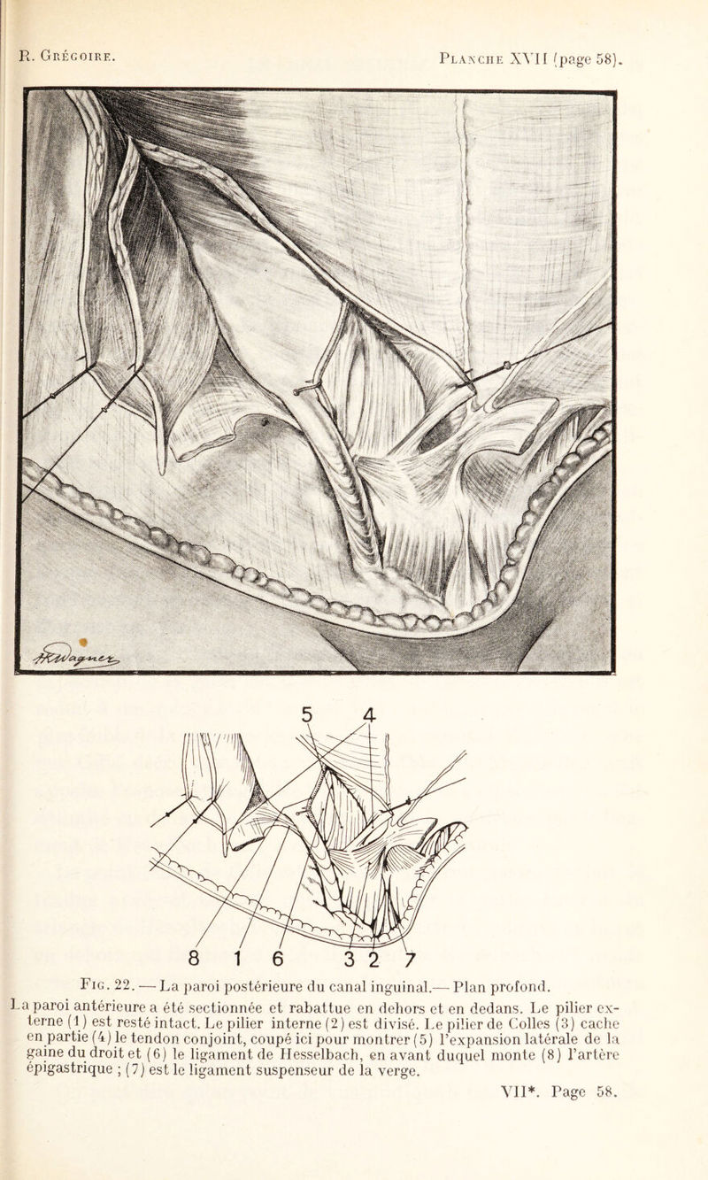 Plaîxciie XYII (page 58) 5 4 Fig. 22. ■— La paroi postérieure du canal inguinal.— Plan profond. La paroi antérieure a été sectionnée et rabattue en dehors et en dedans. Le pilier ex¬ terne (1 ) est resté intact. Le pilier interne (2) est di^dsé. Le pilier de Colles (8) cache en partie (4) le tendon conjoint, coupé ici pour montrer (5) l’expansion latérale de la gaine du droit et (6) le ligament de Hesselbach, en avant duquel monte (8) l’artère épigastrique ; (7) est le ligament suspenseur de la verge.