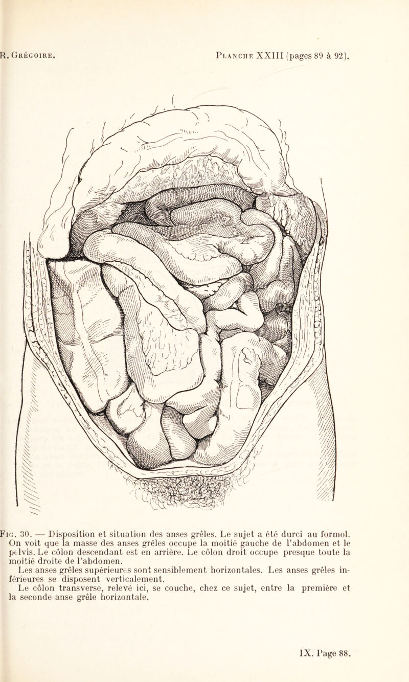 Fie. 30. — Disposition et situation des anses grêles. Le sujet a été durci au formol. On voit que la masse des anses grêles occupe la moitié gauche de l’abdomen et le pelvis. Le côlon descendant est en arrière. Le côlon droit occupe presque toute la moitié droite de l’abdomen. Les anses grêles supérieures sont sensiblement horizontales. Les anses grêles in¬ férieures se disposent verticalement. Le côlon transverse, relevé ici, se couche, chez ce sujet, entre la première et la seconde anse grêle horizontale.