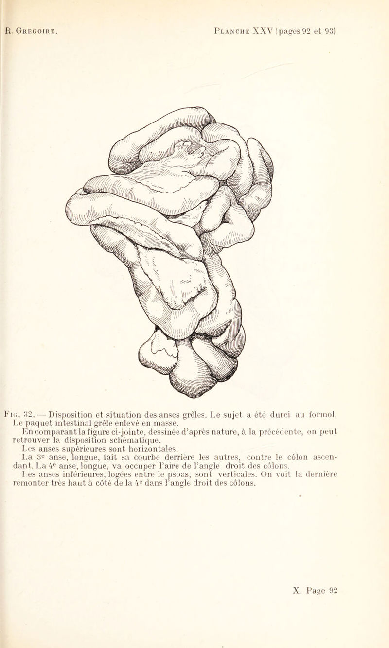 Fig. 32. — Disposition et situation des anses grêles. Le sujet a été durci au formol. Le paquet intestinal grêle enlevé en masse. En comparant la figure ci-jointe, dessinée d’après nature, à la précédente, on peut retrouver la disposition schématique. Les anses supérieures sont horizontales. La 3® anse, longue, fait sa courbe derrière les autres, contre le côlon ascen¬ dant. La 4® anse, longue, va occuper Faire de Fangle droit des côlons. Les anses inférieures, logées entre le psoas, sont verticales. On voit la dernière remonter très haut à côté de la 4® dans l’angle droit des côlons.