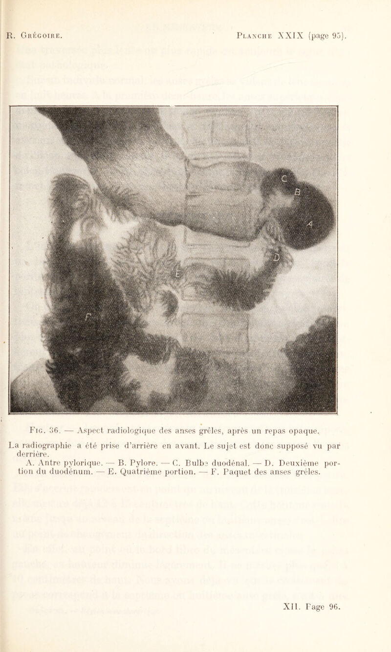 Fig. 36. —■ Aspect radiologiiiue des anses grêles, après un repas opaque. La radiograpliie a été prise d’arrière en avant. Le sujet est donc supposé vu par derrière. A. Antre pylorique. — B. Pylore. — G. Bulbe duodénal. — D. Deuxième por¬ tion du duodénum. — E. Quatrième portion. — F. Paquet des anses grêles.