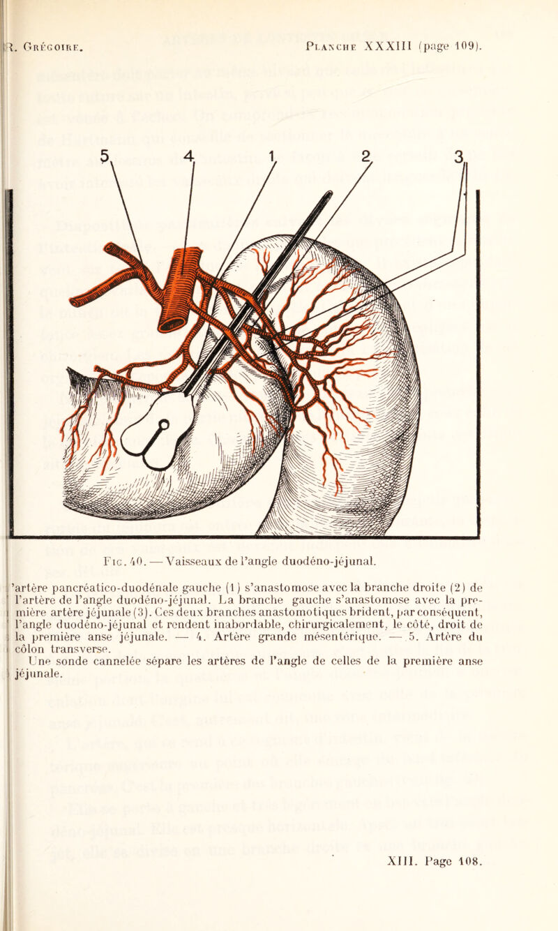 I ( î Fig. 40. —Vaisseaux de l’angle duodéno-jéjunal. î’artère pancréatic.o-duodénale gauche (1) s’anastomose avec la branche droite (2) de j l’artère de l’angle duodéno-jéjunal. La branche gauche s’anastomose avec la pre- 1 mière artère jôjunale (3). Ces deux branches anastomotiques brident, par conséquent, ! l’angle duodéno-jéjunal et rendent inabordable, chirurgicalement, le côté, droit de la première anse jéjunale. — 4. Artère grande mésentérique. — 5. Artère du I côlon transverse. Une sonde cannelée sépare les artères de l’angle de celles de la première anse jéjunale.