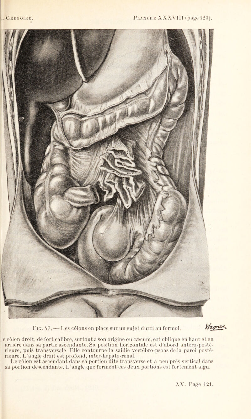 .Grégoire. Planche XXXVIII (page 123). .e côlon droit, de fort calibre, surtout à son origine ou cæcum, est oblique en haut et en arrière dans sa partie ascendante. Sa position horizontale est d’abord antéro-posté¬ rieure, puis transversale. Elle contourne la saillie vertébro-psoas delà paroi posté¬ rieure. L’angle droit est profond, inter-hépato-rénal. Le côlon est ascendant dans sa portion dite transverse et à peu près vertical dans sa portion descendante. L’angle que forment ces deux portions est fortement aigu.