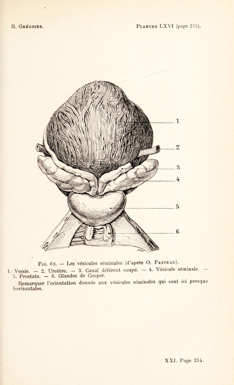 Fig. 69. — Les vésicules séminales (d’après O. Pasteau). 1. Vessie. - 2. Uretère. - 3. Canal déférent coupé. - 4. Vésicule séminale. - 5. Prostate. — 6. Glandes de Cooper. Remarquer l’orientation donnée aux vésicules séminales qui sont ici presque horizontales.