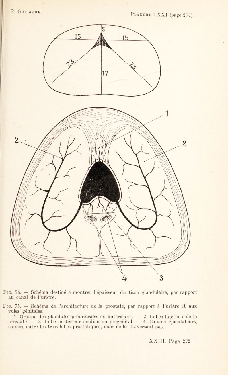Planche LXXI (page 272). 4 3 Fig. 74. — Schéma destiné à montrer l’épaisseur du tissu glandulaire, par rapport au canal de l’urètre. Fig. 75. — Schéma de l’architecture de la prostate, par rapport à l’urètre et aux voies génitales. 1. Groupe des glandules préurétrales ou antérieures. — 2. Lobes latéraux de la prostate. — 3. Lobe postérieur médian ou prégénital. — 4. Canaux éjaculateurs, coincés entre les trois lobes prostatiques, mais ne les traversant pas.