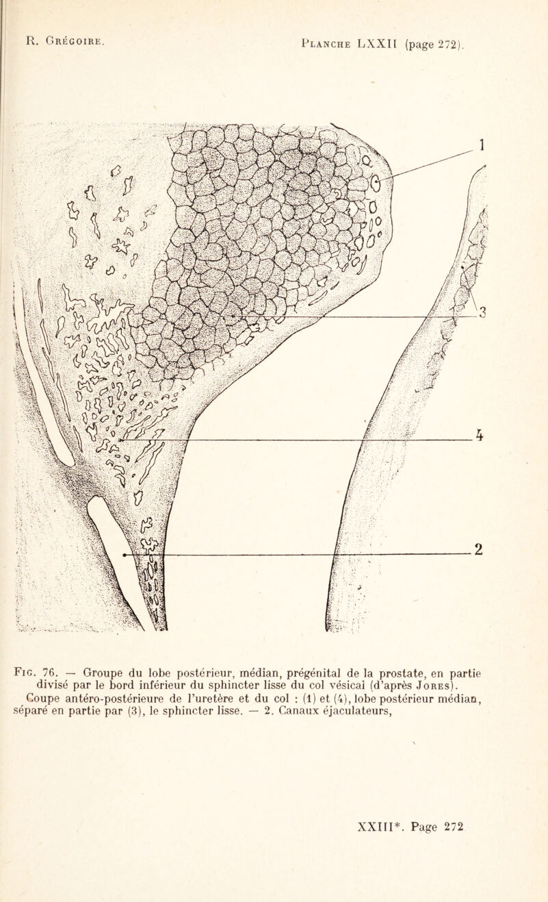 Fig. 76. — Groupe du lobe postérieur, médian, prégénital de la prostate, en partie divisé par le bord inférieur du sphincter lisse du col vésical (d’après Jores). Coupe antéro-postérieure de l’uretère et du col : (1) et (4), lobe postérieur médian, séparé en partie par (3), le sphincter lisse. — 2. Canaux éjaculateurs,