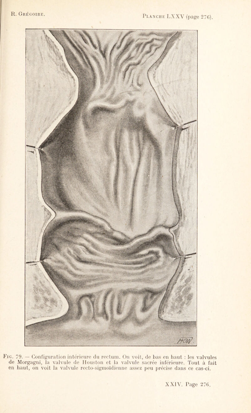 Fig. 79. — Configuration intérieure du rectum. On voit, de bas en haut : les valvules de Morgagni, la valvule de Houston et la valvule sacrée inférieure. Tout à fait en haut, on voit la valvule recto-sigmoïdienne assez peu précise dans ce cas-ci.