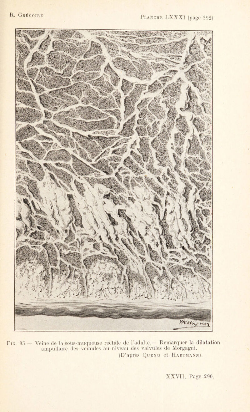 Fig. 85.— Veine de la sous-muqueuse rectale de l’adulte.— Remarquer la dilatation ampullaire des veinules au niveau des valvules de Morgagni. (D’après Quenu et Hartmann).