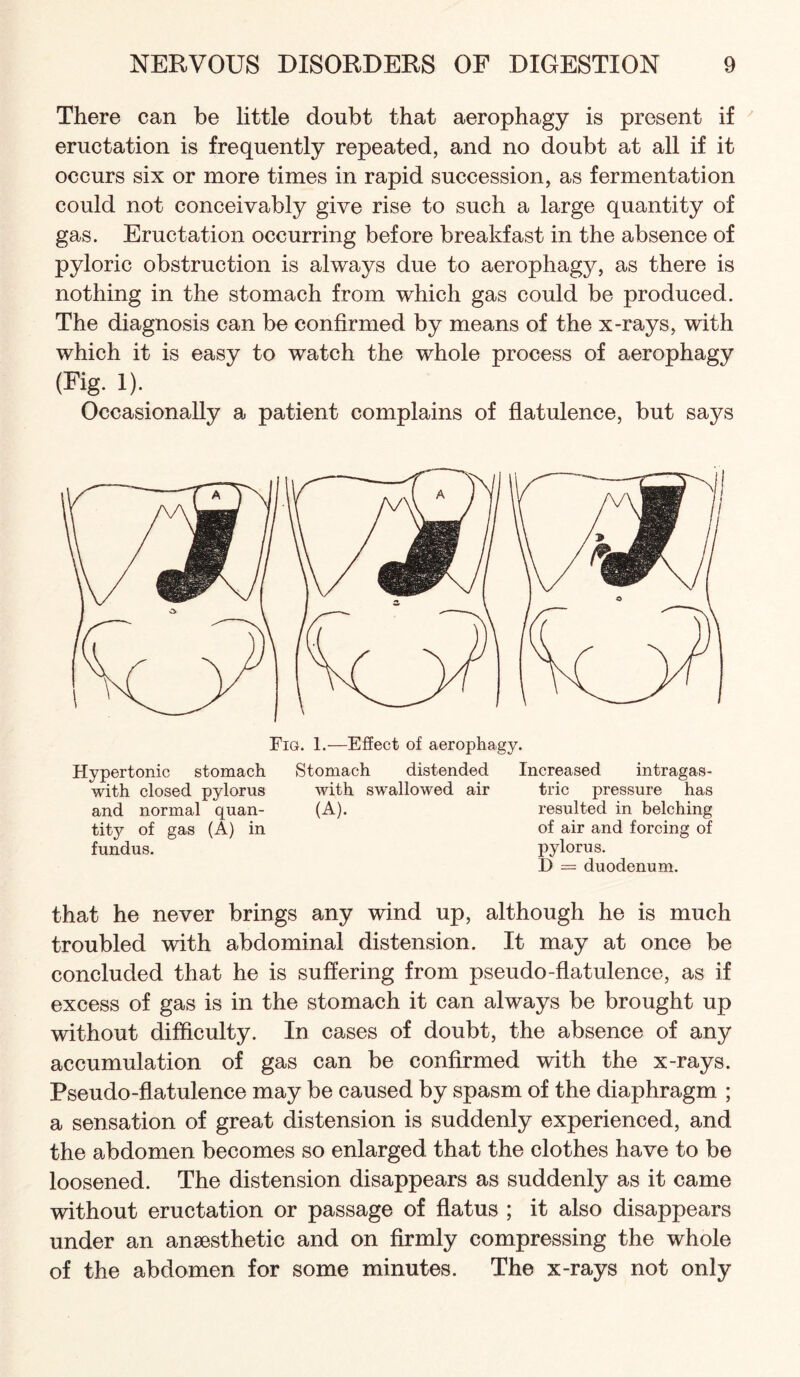 There can be little doubt that aerophagy is present if eructation is frequently repeated, and no doubt at all if it occurs six or more times in rapid succession, as fermentation could not conceivably give rise to such a large quantity of gas. Eructation occurring before breakfast in the absence of pyloric obstruction is always due to aerophagy, as there is nothing in the stomach from which gas could be produced. The diagnosis can be confirmed by means of the x-rays, with which it is easy to watch the whole process of aerophagy (Fig. 1). Occasionally a patient complains of flatulence, but says Fig. 1.—Effect of aerophagy. Hypertonic stomach Stomach distended Increased intragas- with closed pylorus with swallowed air trie pressure has and normal quan- (A). resulted in belching tity of gas (A) in of air and forcing of fundus. pylorus. D = duodenum. that he never brings any wind up, although he is much troubled with abdominal distension. It may at once be concluded that he is suffering from pseudo-flatulence, as if excess of gas is in the stomach it can always be brought up without difficulty. In cases of doubt, the absence of any accumulation of gas can be confirmed with the x-rays. Pseudo-flatulence may be caused by spasm of the diaphragm ; a sensation of great distension is suddenly experienced, and the abdomen becomes so enlarged that the clothes have to be loosened. The distension disappears as suddenly as it came without eructation or passage of flatus ; it also disappears under an anaesthetic and on firmly compressing the whole of the abdomen for some minutes. The x-rays not only