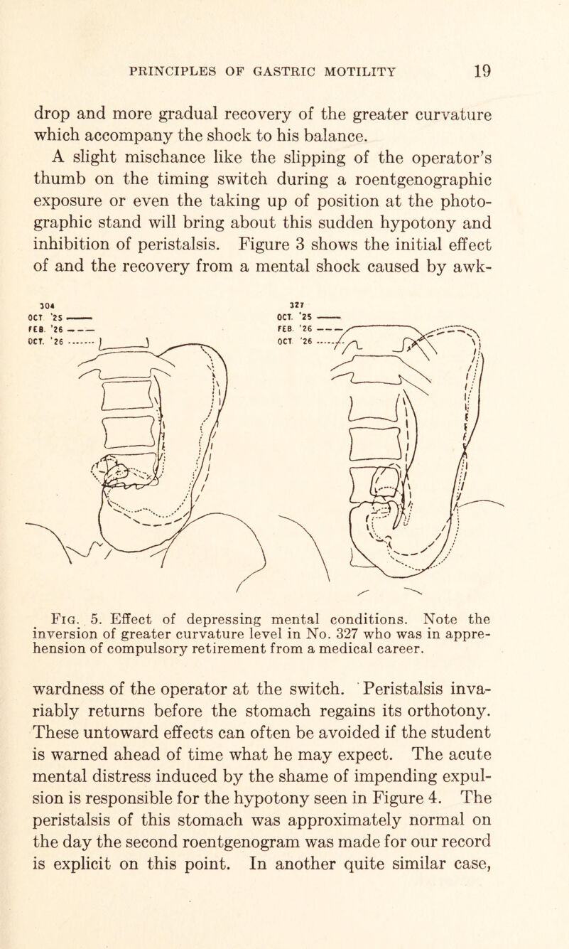 drop and more gradual recovery of the greater curvature which accompany the shock to his balance. A slight mischance like the slipping of the operator’s thumb on the timing switch during a roentgenographic exposure or even the taking up of position at the photo¬ graphic stand will bring about this sudden hypotony and inhibition of peristalsis. Figure 3 shows the initial effect of and the recovery from a mental shock caused by awk- Fig. 5. Effect of depressing mental conditions. Note the inversion of greater curvature level in No. 327 who was in appre¬ hension of compulsory retirement from a medical career. wardness of the operator at the switch. Peristalsis inva¬ riably returns before the stomach regains its orthotony. These untoward effects can often be avoided if the student is warned ahead of time what he may expect. The acute mental distress induced by the shame of impending expul¬ sion is responsible for the hypotony seen in Figure 4. The peristalsis of this stomach was approximately normal on the day the second roentgenogram was made for our record is explicit on this point. In another quite similar case,