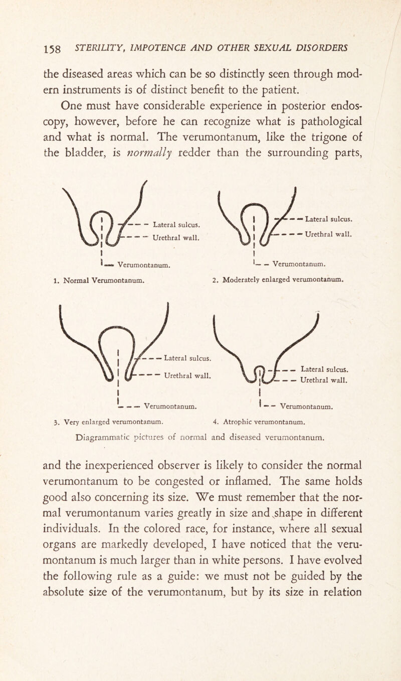 the diseased areas which can be so distinctly seen through mod¬ ern instruments is of distinct benefit to the patient. One must have considerable experience in posterior endos¬ copy, however, before he can recognize what is pathological and what is normal. The verumontanum, like the trigone of the bladder, is normally redder than the surrounding parts, t-Verumontanum. 2. Moderately enlarged verumontanum. 3. Very enlarged verumontanum. 4. Atrophic verumontanum. Diagrammatic pictures of normal and diseased verumontanum. and the inexperienced observer is likely to consider the normal verumontanum to be congested or inflamed. The same holds good also concerning its size. We must remember that the nor¬ mal verumontanum varies greatly in size and Nshape in different individuals. In the colored race, for instance, where all sexual organs are markedly developed, I have noticed that the veru¬ montanum is much larger than in white persons. I have evolved the following rule as a guide: we must not be guided by the absolute size of the verumontanum, but by its size in relation