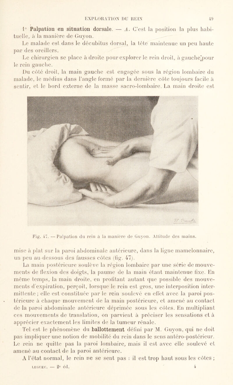 1° Palpation en situation dorsale. — A. C’est la position la plus habi¬ tuelle, à la manière de Guyon. Le malade est dans le décubitus dorsal, la tête maintenue un peu haute par des oreillers. Le chirurgien se place adroite pour explorer le rein droit, à gaucheqiour le rein gauche. Du côté droit, la main gauche est engagée sous la région lombaire du malade, le médius dans l’angle formé par la dernière côte toujours facile à sentir, et le bord externe de la masse sacro-lombaire. La main droite est Fig. 47. —Palpation du rein à la manière de Guyon. Attitude des mains. mise à plat sur la paroi abdominale antérieure, dans la ligne mamelonnaire, un peu au-dessous des fausses côtes (fig. 47). La main postérieure soulève la région lombaire par une série de mouve¬ ments de flexion des doigts, la paume de la main étant maintenue fixe. En même temps, la main droite, en profitant autant que possible des mouve¬ ments d'expiration, perçoit, lorsque le rein est gros, une interposition inter¬ mittente ; elle est constituée par le rein soulevé en effet avec la paroi pos¬ térieure à chaque mouvement de la main postérieure, et amené au contact de la paroi abdominale antérieure déprimée sous les côtes. En multipliant ces mouvements de translation, on parvient à préciser les sensations et à apprécier exactement les limites de la tumeur rénale. Tel est le phénomène du ballottement défini par M. Guyon, qui ne doit pas impliquer une notion de mobilité du rein dans le sens antéro-postérieur. Le rein ne quitte pas la paroi lombaire, mais il est avec elle soulevé et amené au contact de la paroi antérieure. A l’état normal, le rein ne se sent pas : il est trop haut sous les côtes ; LEGUEU. — 2° éd. 4