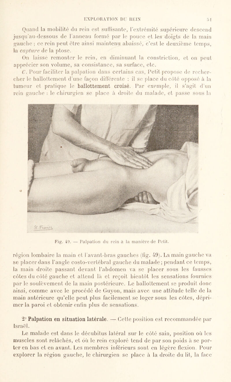Quand la mobilité du rein est suffisante, l’extrémité supérieure descend jusqu’au-dessous de l'anneau formé par le pouce et les doigts de la main gauche ; ce rein peut être ainsi maintenu abaissé, c’est le deuxième temps, la capture de la ptose. On laisse remonter le rein, en diminuant la constriction, et on peut apprécier son volume, sa consistance, sa surface, etc. C. Pour faciliter la palpation dans certains cas, Petit propose de recher¬ cher le ballottement d’une façon différente : il se place du côté opposé à la tumeur et pratique le ballottement croisé. Par exemple, il s’agit d’un rein gauche : le chirurgien se place à droite du malade, et passe sous la Fig. 49. — Palpation du rein à la manière de Petit. région lombaire la main et l’avant-bras gauches (fig. 49). La main gauche va se placer dans l’angle costo-vertébral gauche du malade; pendant ce temps, la main droite passant devant l’abdomen va se placer sous les fausses côtes du côté gauche et attend là et reçoit bientôt les sensations fournies par le soulèvement de la main postérieure. Le ballottement se produit donc ainsi, comme avec le procédé de Guyon, mais avec une attitude telle de la main antérieure qu’elle peut plus facilement se loger sous les côtes, dépri¬ mer la paroi et obtenir enfin plus de sensations. Palpation en situation latérale. —- Cette position est recommandée par Israël. Le malade est dans le décubitus latéral sur le côté sain, position où les muscles sont relâchés, et où le rein exploré tend de par son poids à se por¬ ter en bas et en avant. Les membres inférieurs sont en légère flexion. Pour explorer la région gauche, le chirurgien se place à la droite du lit, la face