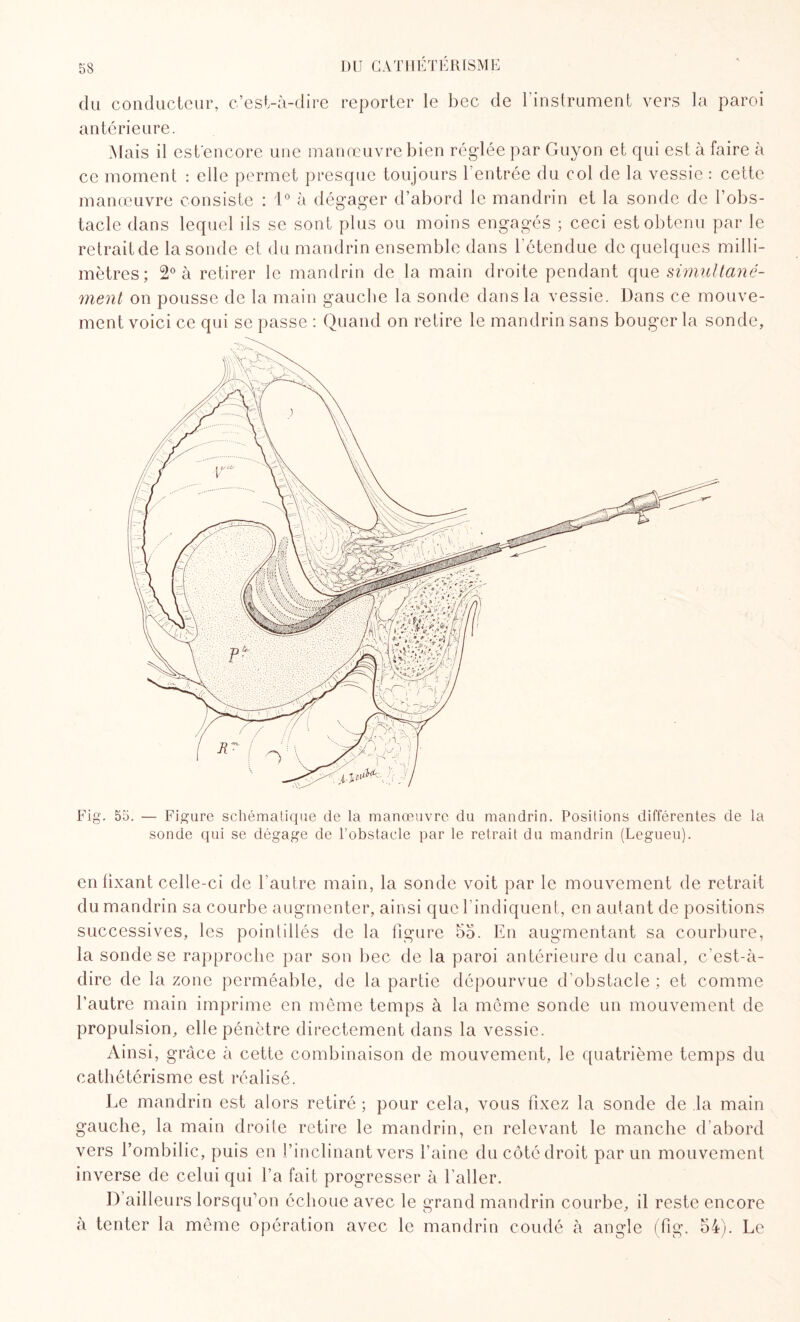 du conducteur, c’est-à-dire reporter le bec de l'instrument vers la paroi antérieure. Mais il estencore une manœuvre bien régdée par Guyon et qui est à faire à ce moment : elle permet presque toujours l’entrée du col de la vessie : cette manœuvre consiste : 1° à dégager d’abord le mandrin et la sonde de l’obs¬ tacle dans lequel ils se sont plus ou moins engagés ; ceci est obtenu par le retrait de la sonde et du mandrin ensemble dans l'étendue de quelques milli¬ mètres; 2° à retirer le mandrin de la main droite pendant que simultané¬ ment on pousse de la main gauche la sonde dans la vessie. Dans ce mouve¬ ment voici ce qui se passe : Quand on relire le mandrin sans bouger la sonde, Fig. 55. — Figure schématique de la manœuvre du mandrin. Positions différentes de la sonde qui se dégage de l’obstacle par le retrait du mandrin (Legueu). en fixant celle-ci de l’autre main, la sonde voit par le mouvement de retrait du mandrin sa courbe augmenter, ainsi que l’indiquent, en autant de positions successives, les pointillés de la figure 55. En augmentant sa courbure, la sonde se rapproche par son bec de la paroi antérieure du canal, c'est-à- dire de la zone perméable, de la partie dépourvue d'obstacle ; et comme l’autre main imprime en même temps à la même sonde un mouvement de propulsion, elle pénètre directement dans la vessie. Ainsi, grâce à cette combinaison de mouvement, le quatrième temps du cathétérisme est réalisé. Le mandrin est alors retiré ; pour cela, vous fixez la sonde de la main gauche, la main droite retire le mandrin, en relevant le manche d'abord vers l’ombilic, puis en l’inclinant vers l’aine du côté droit par un mouvement inverse de celui qui l’a fait progresser à l’aller. D’ailleurs lorsqu’on échoue avec le grand mandrin courbe, il reste encore à tenter la même opération avec le mandrin coudé à angle (fig. 54). Le