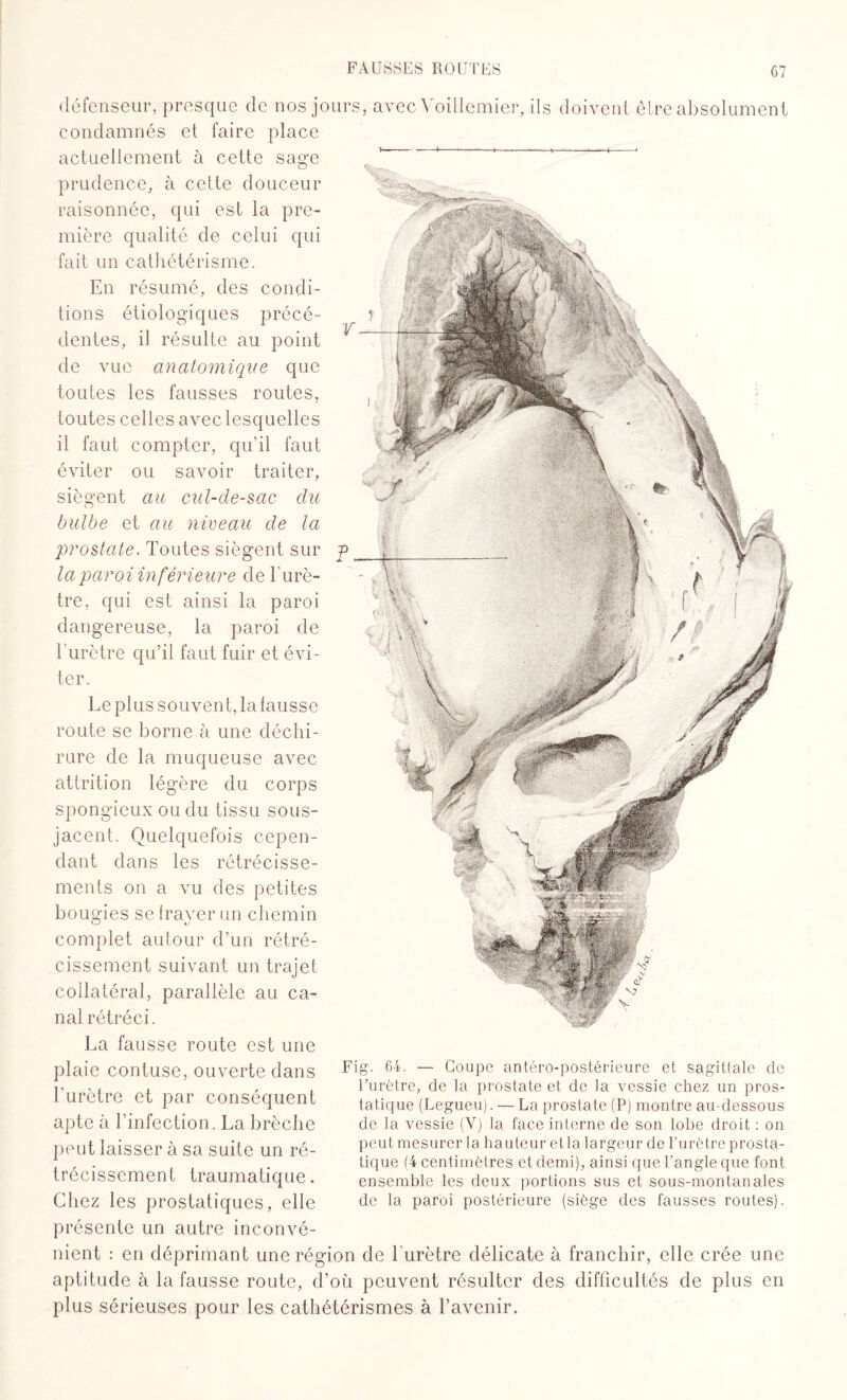 défenseur, presque de nos jours, avec Voillemier, ils doivent être absolument condamnés et faire place actuellement à cette sage 1 ‘ ^ ' O prudence, à cette douceur raisonnée, qui est la pre¬ mière qualité de celui qui fait un cathétérisme. En résumé, des condi¬ tions étiologiques précé¬ dentes, il résulte au point de vue anatomique que toutes les fausses routes, toutes celles avec lesquelles il faut compter, qu’il faut éviter ou savoir traiter, siègent au cul-de-sac du bulbe et au niveau de la prostate. Toutes siègent sur la paroi inférieure de l’urè¬ tre, qui est ainsi la paroi dangereuse, la paroi de T urètre qu’il faut fuir et évi¬ ter. Le plus souvent, la fausse route se borne à une déchi¬ rure de la muqueuse avec attrition légère du corps spongieux ou du tissu sous- jacent. Quelquefois cepen¬ dant dans les rétrécisse¬ ments on a vu des petites bougies se frayer un chemin complet autour d’un rétré¬ cissement suivant un trajet collatéral, parallèle au ca¬ nal rétréci. La fausse route est une plaie contuse, ouverte dans l’urètre et par conséquent apte à l’infection. La brèche peut laisser à sa suite un ré¬ trécissement traumatique. Chez les prostatiques, elle présente un autre inconvé¬ nient : en déprimant une région de l’urètre délicate à franchir, elle crée une aptitude à la fausse route, d’où peuvent résulter des difficultés de plus en plus sérieuses pour les cathétérismes à l’avenir. Fig. 64. — Coupe antéro-postérieure et sagittale de l’urètre, de la prostate et de la vessie chez un pros¬ tatique (Legueu). — La prostate (P) montre au-dessous de la vessie (V) la face interne de son lobe droit : on peut mesurer la hauteur etla largeur de l’urètre prosta¬ tique (4 centimètres et demi), ainsi que l’angle que font ensemble les deux portions sus et sous-mon tan aies de la paroi postérieure (siège des fausses routes).