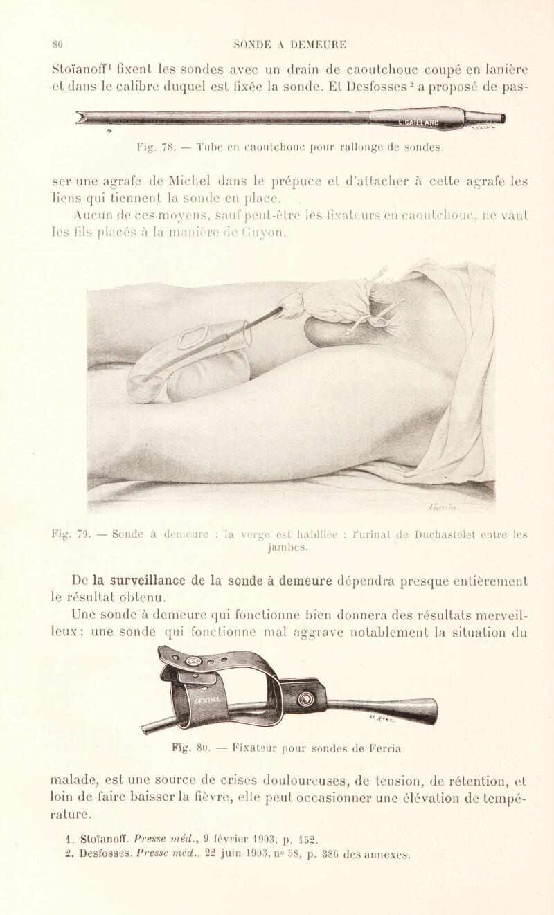 Stoïanoff1 fixent les sondes avec un drain de caoutchouc coupé en lanière et dans le calibre duquel est fixée la sonde. Et Desfosses2 a proposé de pas- Fig. 78. — Tube en caoutchouc pour rallonge de sondes. ser une agrafe de Michel dans le prépuce et d’attacher à cette agrafe les liens qui tiennent la sonde en place. Aucun de ces moyens, sauf peut-être les fixateurs en caoutchouc, 11c vaut les fils placés à la manière de Guyon. Fig. 79. — Sonde à demeure : la verge est habillée : F urinai de Duchastelet entre les jambes. De la surveillance de la sonde à demeure dépendra presque entièrement le résultat obtenu. Une sonde à demeure qui fonctionne bien donnera des résultats merveil¬ leux; une sonde qui fonctionne mal aggrave notablement la situation du Fig. 80. — Fixateur pour sondes de Ferria malade, est une source de crises douloureuses, de tension, de rétention, et loin de faire baisser la fièvre, elle peut occasionner une élévation de tempé¬ rature. 1. Stoïanoff. Presse méd., 9 février 1903, p, 152. 2. Desfosses. Presse méd., 22 juin 1903, n° 58, p. 386 des annexes.