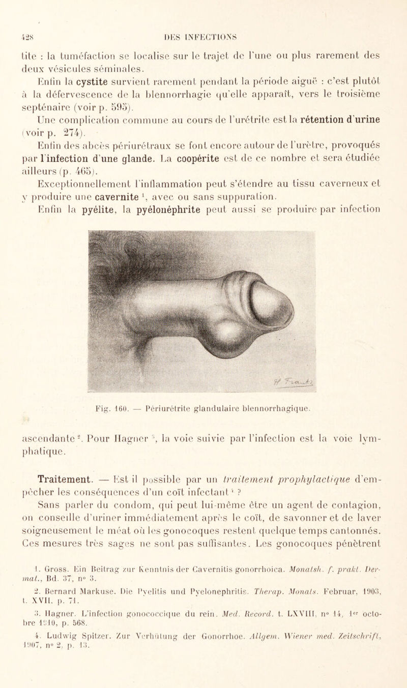 titc : la tuméfaction se localise sur le trajet de l'une ou plus rarement des deux vésicules séminales. Enfin la cystite survient rarement pendant la période aiguë : c’est plutôt à la défervescence de la blennorrhagie qu’elle apparaît, vers le troisième septénaire (voirp. 595). Une complication commune au cours de I urétrite est la rétention d urine (voir p. 274). Enfin des abcès périurétraux se font encore autour de l’urètre, provoqués par 1 infection d’une glande. La coopérite est de ce nombre et sera étudiée ailleurs (p. 465). Exceptionnellement l’inflammation peut s’étendre au tissu caverneux et y produire une cavernite L avec ou sans suppuration. Enfin la pyélite, la pyélonéphrite peut aussi se produire par infection Fig. 160. — Périurétrite glandulaire blennorrhagique. ascendante-. Pour Hagner 3 4, la voie suivie par l’infection est la voie lym¬ phatique. Traitement. — Est il possible par un traitement prophylactique d’em- pècher les conséquences d’un coït infectant1 2 ? Sans parler du condom, qui peut lui-même être un agent de contagion, on conseille d’uriner immédiatement après le coït, de savonner et de laver soigneusement le méat où les gonocoques restent quelque temps cantonnés. Ces mesures très sages ne sont pas suffisantes. Les gonocoques pénètrent 1. Gross. Fin Beitrag zur Kenntnis der Cavernitis gonorrhoica. Monatsh. f. prakt. Ver- mat., Bd. 37, n° 3. 2. Bernard Markuse. Die Pyelitis und Pvelonephritis. Therap. Monats. Februar. 1903, t. XVII. p. 71. 3. Hagner. L’infection gonococcique du rein. Med. Record, t. LXVIH, n° 14, 1er octo¬ bre 1910, p. 568. 4. Ludwig Spitzer. Zur Verhiitung der Gonorrlioe. Allgern. Wiener med. Zeitschrift, 1907, n° 2, p. 13.