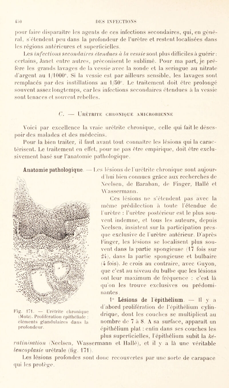 pour faire disparaître les agents de ces infections secondaires, qui, en géné¬ ral, s’étendent peu dans la profondeur de l’urètre et restent localisées dans les régions antérieures et superficielles. Les infections secondaires étendues à la vessie sont plus difficiles à guérir : certains, Janet entre autres, préconisent le sublimé. Pour ma part, je pré¬ fère les grands lavages de la vessie avec la sonde et la seringue au nitrate d’argent au 1 /1000e. Si la vessie est par ailleurs sensible, les lavages sont remplacés par des instillations au l/50'!. Le traitement doit être prolongé souvent assez longtemps, caries infections secondaires étendues à la vessie sont tenaces et souvent rebelles. C. Urétrite chronique amicrobienne Voici par excellence la vraie urétrite chronique, celle qui fait le déses¬ poir des malades et des médecins. Pour la bien traiter, il faut avant tout connaître les lésions qui la carac¬ térisent. Le traitement en effet, pour ne pas être empirique, doit être exclu¬ sivement basé sur l’anatomie pathologique. Anatomie pathologique. — Les lésions de l'urétrite chronique sont aujour- d hui bien connues grâce aux recherches de Xeelsen, de Baraban, de Finger, Il allé et Wassermann. Ces lésions ne s’étendent pas avec la même prédilection à toute l'étendue de l’urètre : l’urètre postérieur est le plus sou¬ vent indemne, et tous les auteurs, depuis Xeelsen, insistent sur la participation pres¬ que exclusive de l urètre antérieur. D'après Finger, les lésions se localisent plus sou¬ vent dans la partie spongieuse (17 fois sur 34), dans la partie spongieuse et bulbaire (4 fois). Je crois au contraire, avec Guyon, que c’est au niveau du bulbe que les lésions ont leur maximum de fréquence : c’est là qu’on les trouve exclusives ou prédomi¬ nantes . 1° Lésions de lepithélium. — Il y a d’abord prolifération de l’épithélium cylin¬ drique, dont les couches se multiplient au nombre de 7 à 8. A sa surface, apparaît un épithélium plat : enfin dans ses couches les plus superficielles, l'épithélium subit la ké¬ ratinisation (Xeelsen, Wassermann et Hallé), et il y a là une véritable leucoplasie urétrale (fig. 171). Les lésions profondes sont donc recouvertes par une sorte de carapace qui les protège.  •» «Nlt A’ .U-v*. * • »•*. , !0g. 171. — Urétrite chronique (Motz). Prolifération épithéliale : éléments glandulaires dans la profondeur.