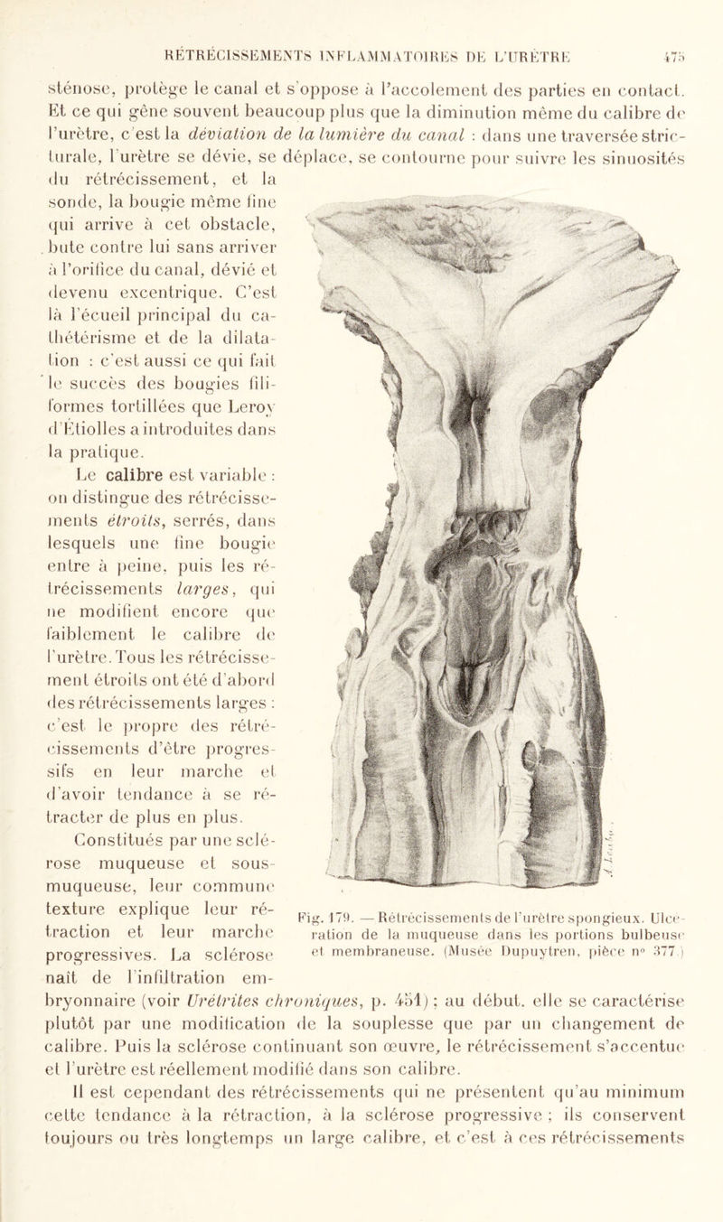 sténose, protège le canal et s oppose à l’accolement des parties en contact. Et ce qui gêne souvent beaucoup plus que la diminution même du calibre de l’urètre, c’est la déviation de la lumière du canal : dans une traversée stric- lurale, l’urètre se dévie, se déplace, se contourne pour suivre les sinuosités du rétrécissement, et la sonde, la bougie même fine qui arrive à cet obstacle, bute contre lui sans arriver à l’orifice du canal, dévié et devenu excentrique. C’est là l’écueil principal du ca¬ thétérisme et de la dilata¬ tion : c’est aussi ce qui fait * le succès des bougies fili¬ formes tortillées que Leroy d Étiolles a introduites dans la pratique. Le calibre est variable : on distingue des rétrécisse¬ ments étroits, serrés, dans lesquels une fine bougie entre à peine, puis les ré¬ trécissements larges, qui ne modifient encore que faiblement le calibre de l’urètre. Tous les rétrécisse¬ ment étroits ont été d’abord des rétrécissements larges : c’est le propre des rétré¬ cissements d’être progres¬ sifs en leur marche et d’avoir tendance à se ré¬ tracter de plus en plus. Constitués par une sclé¬ rose muqueuse et sous- muqueuse, leur commune texture explique leur ré¬ traction et leur marche progressives. La sclérose naît de lin filtration em¬ bryonnaire (voir Urétrites chroniques, p. 451) ; au début, elle se caractérise plutôt par une modification de la souplesse que par un changement de calibre. Puis la sclérose continuant son œuvre, le rétrécissement s’accentue et l’urètre est réellement modifié dans son calibre. Il est cependant des rétrécissements qui ne présentent qu’au minimum cette tendance à la rétraction, à la sclérose progressive ; ils conservent toujours ou très longtemps un large calibre, et c’est à ces rétrécissements Rétrécissements de l'urètre spongieux. Ulcé¬ ration de la muqueuse dans les portions bulbeuse et membraneuse. (Musée Dupuytren, pièce n° 377.)