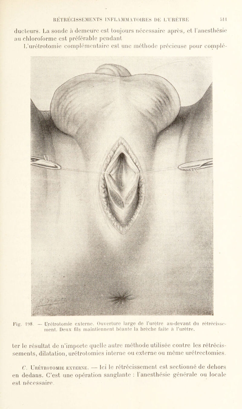 ducteurs. La sonde à demeure est toujours nécessaire après, et l’anesthésie au chloroforme est préférable pendant L’urétrotomie complémentaire est une méthode précieuse pour complé- Fig. 198, — Urétrotomie externe. Ouverture large de l’urètre au-devant du rétrécisse¬ ment. Deux fds maintiennent béante la brèche faite à l’urètre. ter le résultat de n’importe quelle autre méthode utilisée contre les rétrécis¬ sements, dilatation, urétrotomies interne ou externe ou même urétrectomies. C. Urétrotomie externe. — Ici le rétrécissement est sectionné de dehors en dedans. C’est une opération sanglante : l’anesthésie générale ou locale est nécessaire.