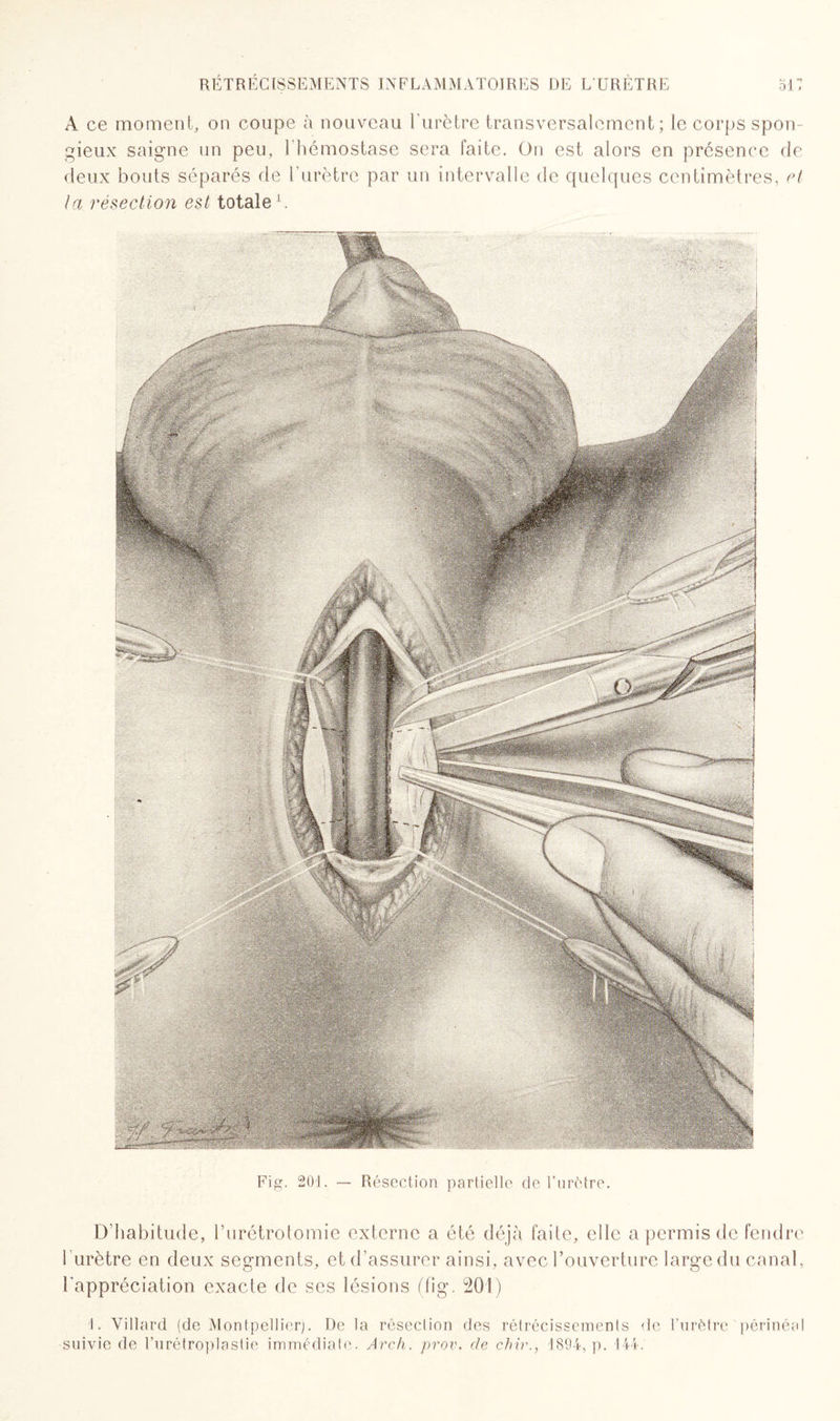 A ce moment, on coupe à nouveau l'urètre transversalement; le corps spon¬ gieux saigne un peu, 1 hémostase sera faite. On est alors en présence de deux bouts séparés de l’urètre par un intervalle de quelques centimètres, et ta résection est totale1. D’habitude, l’urétrotomie externe a été déjà faite, elle a permis de fendre 1 urètre en deux segments, et d’assurer ainsi, avec l’ouverture large du canal, l’appréciation exacte de ses lésions (fîg. 201) 1. Villard (de Montpellier). De la réseclion des rétrécissements de l’urètre périnéal suivie de Turétroplastie immédiate. Arch. prov. de chir., 1894, p. 144.