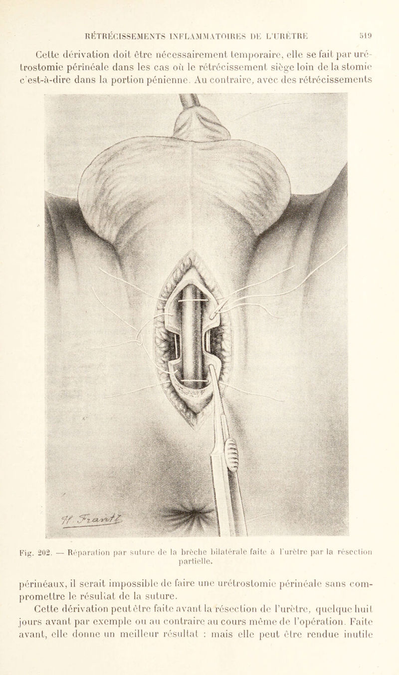 Cette dérivation doit être nécessairement temporaire, elle se l'ait par uré¬ trostomie périnéale dans les cas où le rétrécissement siège loin de la stomie c’est-à-dire dans la portion pénienne. Au contraire, avec des rétrécissements Fig. 202. — Réparation par suture de la brèche bilatérale faite à l'urètre par la résection partielle. périnéaux, il serait impossible de faire une urétrostomie périnéale sans com¬ promettre le résultat de la suture. Cette dérivation peutêtre faite avant la résection de l’urètre, quelque huit jours avant par exemple ou au contraire au cours même de l’opération. Faite avant, elle donne un meilleur résultat : mais elle peut être rendue inutile