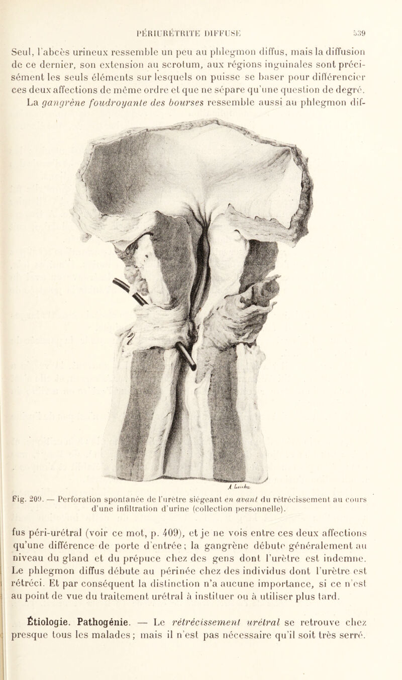 Seul, l’abcès urineux ressemble un peu au phlegmon diffus, mais la diffusion de ce dernier, son extension au scrotum, aux régions inguinales sont préci¬ sément les seuls éléments sur lesquels on puisse se baser pour différencier ces deux affections de même ordre et que ne sépare qu’une question de degré. La gangrène foudroyante des bourses ressemble aussi au phlegmon dif- Fig. 209. — Perforation spontanée de l'urètre siégeant en avant du rétrécissement au cours d'une infiltration d'urine (collection personnelle). fus péri-urétral (voir ce mot, p. 409), et je ne vois entre ces deux affections qu’une différence de porte d’entrée; la gangrène débute généralement au niveau du gland et du prépuce chez des gens dont l’urètre est indemne. Le phlegmon diffus débute au périnée chez des individus dont l’urètre est rétréci. Et par conséquent la distinction n’a aucune importance, si ce n'est au point de vue du traitement urétrai à instituer ou à utiliser plus tard. Étiologie. Pathogénie. — Le rétrécissement urétrai se retrouve chez presque tous les malades; mais il n’est pas nécessaire qu’il soit très serré.