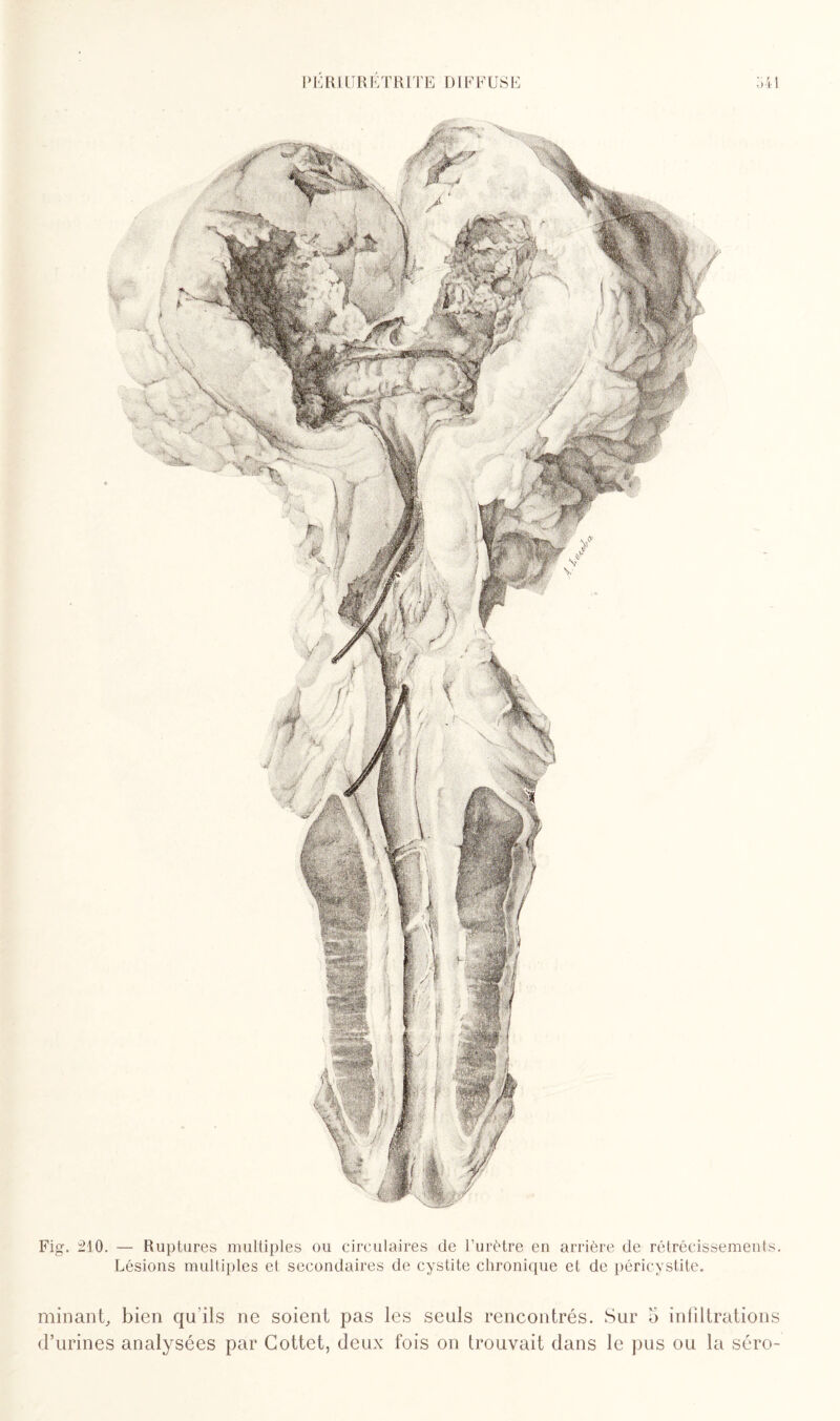 Fig. 210. — Ruptures multiples ou circulaires de l’urètre en arrière de rétrécissements. Lésions multiples et secondaires de cystite chronique et de péricystite. minant, bien qu'ils ne soient pas les seuls rencontrés. Sur 5 infiltrations d’urines analysées par Gottet, deux fois on trouvait dans le pus ou la séro-
