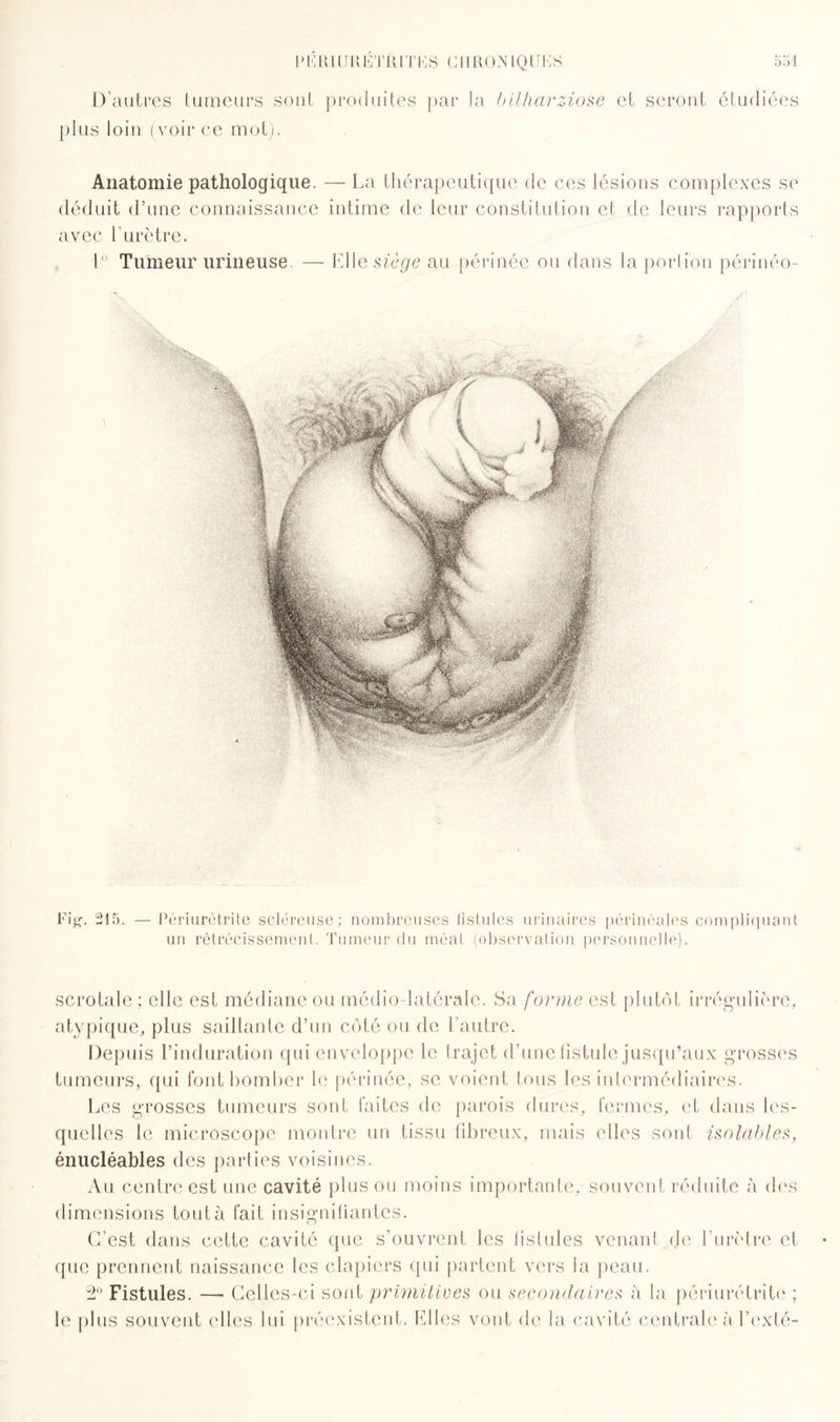 I » K Rf IJRETRIT ES Cfl RONIQU ES Soi D’autres tumeurs soûl produites par la bilharziose et seront étudiées plus loin (voir ce mot). Anatomie pathologique. — La thérapeutique de ces lésions complexes se déduit d’une connaissance intime de leur constitution et. de leurs rapports avec l'urètre. Fig. 215. — Périurétrite scléreuse; nombreuses lislules urinaires périnéales compliquant un rétrécissement. Tumeur du méat (observation personnelle). scrotale ; elle est médiane ou médio-latérale. Sa forme est plutôt irrégulière, atypique, plus saillante d’un côté ou de l’autre. Depuis l’induration qui enveloppe le trajet d’une fistule jusqu’aux grosses tumeurs, qui font bomber le périnée, se voient tous les intermédiaires. Les grosses tumeurs sont faites de parois dures, fermes, et dans les¬ quelles le microscope montre un tissu fibreux, mais elles sont isoiables, énucléables des parties voisines. Au centre est une cavité plus ou moins importante, souvent réduite à des dimensions tout à fait insignifiantes. O C’est dans cette cavité que s’ouvrent les fistules venant de l’urètre et que prennent naissance les clapiers qui partent vers la peau. 2° Fistules. — Celles-ci sont primitives ou secondaires à la périurétrite ; le plus souvent ('lies lui préexistent. Elles vont de la cavité centrale à l’exté-