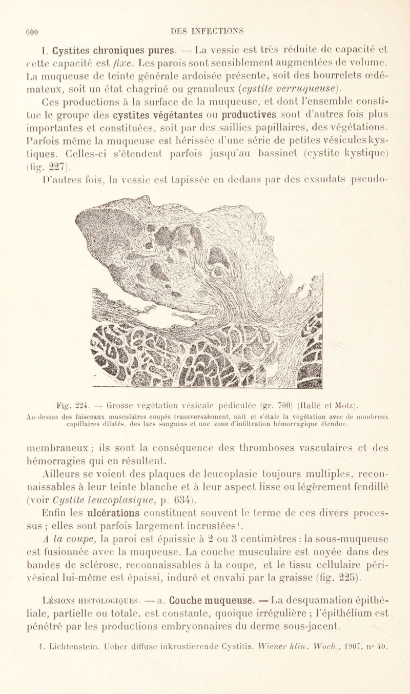 I. Cystites chroniques pures. — La vessie est très réduite de capacité et cette capacité est fixe. Les parois sont sensiblement augmentées de volume. La muqueuse de teinte générale ardoisée présente, soit des bourrelets œdé¬ mateux, soit un état chagriné ou granuleux (cystite verruqueuse). Ces productions à la surface de la muqueuse, et dont l’ensemble consti¬ tue le groupe des cystites végétantes ou productives sont d’autres fois plus importantes et constituées, soit par des saillies papillaires, des végétations. Parfois même la muqueuse est hérissée d’une série de petites vésicules kys¬ tiques. Celles-ci s’étendent parfois jusqu’au bassinet (cystite kystique) (fig. 227). D’autres fois, la vessie est tapissée en dedans par des exsudais pseudo- Fig. 224. — Crosse végétation vésicale pédiculée (gr. 700) (Hallé et Molz). Au-dessus des faisceaux musculaires coupés transversalement, naît et s’étale la végétation avec de nombreux capillaires dilatés, des lacs sanguins et une zone d’infiltration hémorragique étendue. membraneux ; ils sont la conséquence des thromboses vasculaires et des hémorragies qui en résultent. Ailleurs se voient des plaques de leucoplasie toujours multiples, recon¬ naissables à leur teinte blanche et à leur aspect lisse ou légèrement fendillé (voir Cystite leucoplasique, p. 634). Enfin les ulcérations constituent souvent le terme de ces divers proces¬ sus ; elles sont parfois largement incrustées1. A la coupe, la paroi est épaissie à 2 ou 3 centimètres : la sous-muqueuse est fusionnée avec la muqueuse. La couche musculaire est noyée dans des bandes de sclérose, reconnaissables à la coupe, et le tissu cellulaire péri- vésical lui-même est épaissi, induré et envahi par la graisse (fig. 225). Lésions histologiques. — a. Couche muqueuse. — La desquamation épithé¬ liale, partielle ou totale, est constante, quoique irrégulière ; l’épithélium est pénétré par les productions embryonnaires du derme sous-jacent. 1. Lichtenstein. Ueber diffuse inkrustierende Cystilis. Wiener klin. Woch., 1907, n° 40.