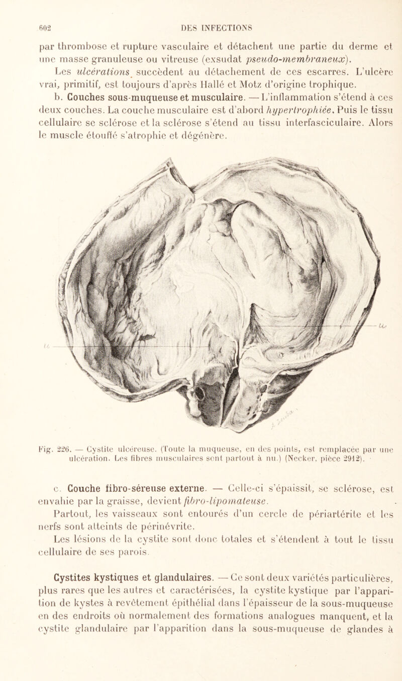 par thrombose et rupture vasculaire et détachent une partie du derme et une masse granuleuse ou vitreuse (exsudât pseudo-membraneux). Les ulcérations succèdent au détachement de ces escarres. L’ulcère vrai, primitif, est toujours d’après Hallé et Motz d’origine trophique. b. Couches sous-muqueuse et musculaire. —L’inflammation s’étend à ces deux couches. La couche musculaire est d’abord hypertrophiée. Puis le tissu cellulaire se sclérose et la sclérose s’étend au tissu interlasciculaire. Alors le muscle étouffé s’atrophie et dégénère. Fig. 226. — Cystite ulcéreuse, ('toute la muqueuse, en des points, est remplacée par une ulcération. Les fibres musculaires sont partout à nu.) (Necker, pièce 2912). • c. Couche fibro-séreuse externe. — Celle-ci s’épaissit, se sclérose, est envahie par la graisse, devient fibro-lipomateuse. Partout, les vaisseaux sont entourés d’un cercle de périartérite et les nerfs sont atteints de périnévrite. Les lésions de la cystite sont donc totales et s’étendent à tout le tissu cellulaire de ses parois. Cystites kystiques et glandulaires. — Ce sont deux variétés particulières, plus rares que les autres et caractérisées, la cystite kystique par l’appari¬ tion de kystes à revêtement épithélial dans l’épaisseur de la sous-muqueuse en des endroits où normalement des formations analogues manquent, et la cystite glandulaire par l’apparition dans la sous-muqueuse de glandes à