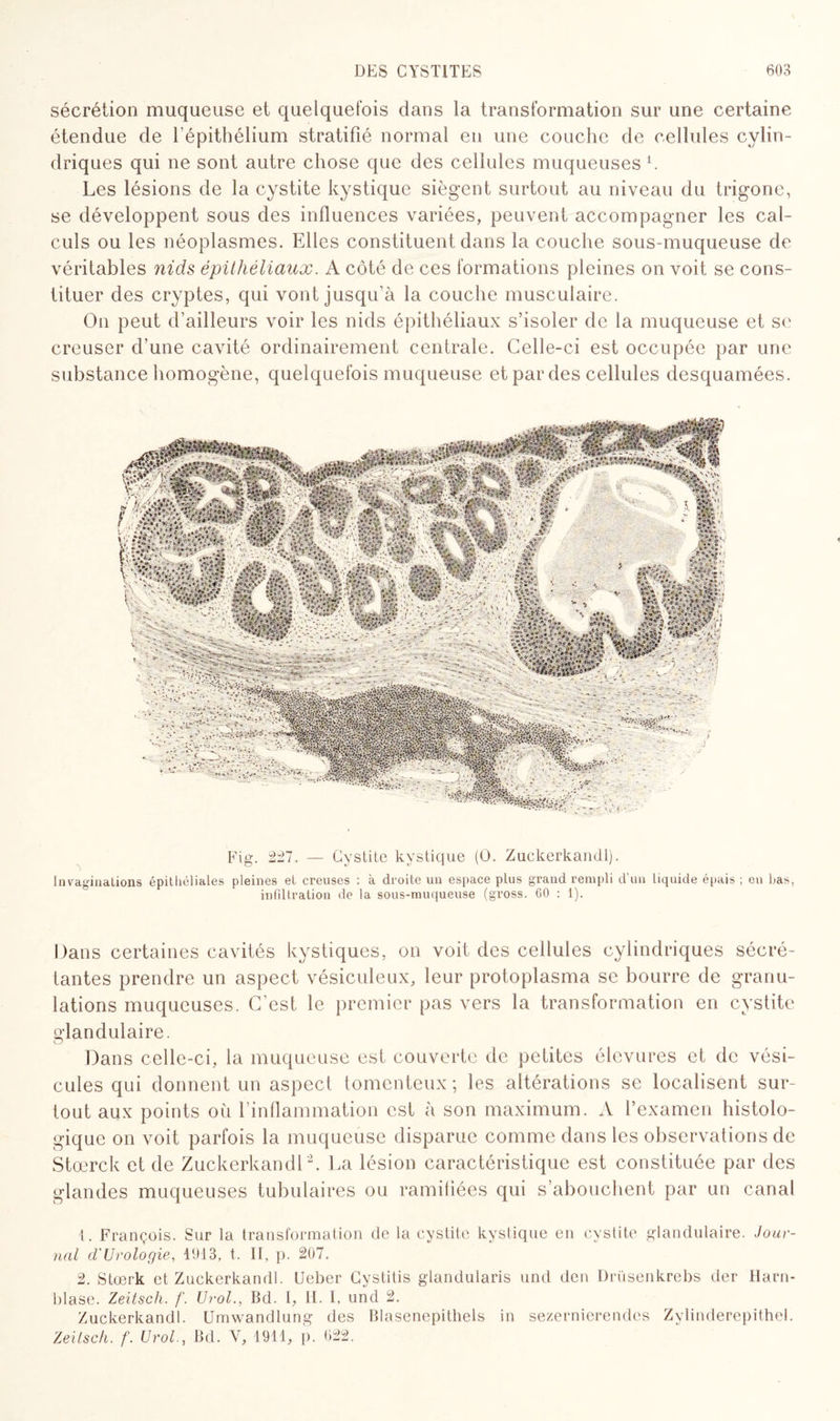 sécrétion muqueuse et quelquefois dans la transformation sur une certaine étendue de l’épithélium stratifié normal en une couche de cellules cylin¬ driques qui ne sont autre chose que des cellules muqueuses1. Les lésions de la cystite kystique siègent surtout au niveau du trigone, se développent sous des influences variées, peuvent accompagner les cal¬ culs ou les néoplasmes. Elles constituent dans la couche sous-muqueuse de véritables nids épithéliaux. A côté de ces formations pleines on voit se cons¬ tituer des cryptes, qui vont jusqu’à la couche musculaire. On peut d’ailleurs voir les nids épithéliaux s’isoler de la muqueuse et se creuser d’une cavité ordinairement centrale. Celle-ci est occupée par une substance homogène, quelquefois muqueuse et par des cellules desquamées. Fig. 227. — Cystite kystique (O. Zuekerkandl). Invaginations épithéliales pleines et creuses : à droite un espace plus grand rempli d'un liquide épais ; eu bas, infiltration de la sous-muqueuse (gross. 60 : 1). Dans certaines cavités kystiques, on voit des cellules cylindriques sécré¬ tantes prendre un aspect vésiculeux, leur protoplasma se bourre de granu¬ lations muqueuses. C'est le premier pas vers la transformation en cystite glandulaire. Dans celle-ci, la muqueuse est couverte de petites élevures et de vési¬ cules qui donnent un aspect tomenteux; les altérations se localisent sur¬ tout aux points où l’inflammation est à son maximum. A l’examen histolo¬ gique on voit parfois la muqueuse disparue comme dans les observations de Stoerck et de Zuekerkandl2. La lésion caractéristique est constituée par des glandes muqueuses tubulaires ou ramifiées qui s’abouchent par un canal 1. François. Sur la transformation de la cystite kystique en cystite glandulaire. Jour¬ nal d'Urologie, 1913, t. II, p. 207. 2. Stœrk et Zuekerkandl. Ueber Cystitis glandularis und den Drüsenkrebs der Harn- blase. Zeitsch. f. Urol., Bd. I, II. I, und 2. Zuekerkandl. ümwandlung des Blasenepithels in sezernierendes Zylinderepithel. Zeitsch. f. Urol., Bd. V, 1911, p. 022.