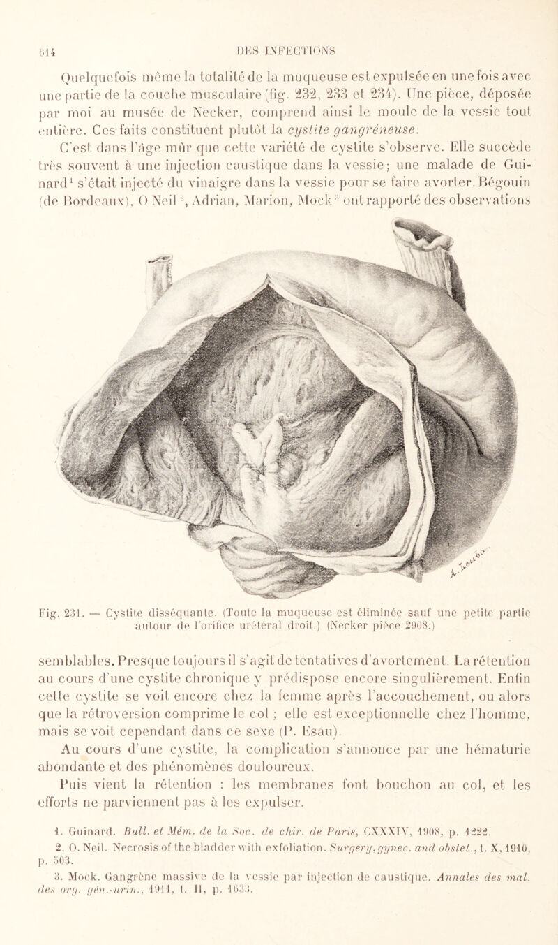 Quelquefois même la totalité de la muqueuse est expulsée en une fois avec une partie de la couche musculaire (fig. 232, 233 et 234). Une pièce, déposée par moi au musée de Necker, comprend ainsi le moule de la vessie tout entière. Ces faits constituent plutôt la cystite gangréneuse. C’est dans Page mûr que cette variété de cystite s’observe. Elle succède très souvent à une injection caustique dans la vessie; une malade de Gui- nard1 s’était injecté du vinaigre dans la vessie pour se faire avorter. Bégouin (de Bordeaux), O Neil2 3, Adrian, Marion, Mock11 ont rapporté des observations Fig. 231. — Cystite disséquante. (Toute la muqueuse est éliminée sauf une petite partie autour de l’orifice urétéral droit.) (Necker pièce 2908.) semblables. Presque toujours il s’agit de tentatives d'avortement. La rétention au cours d’une cystite chronique y prédispose encore singulièrement. Enfin cette cystite se voit encore chez la femme après l'accouchement, ou alors que la rétroversion comprime le col ; elle est exceptionnelle chez l'homme, mais se voit cependant dans ce sexe (P. Esau). Au cours d’une cystite, la complication s’annonce par une hématurie abondante et des phénomènes douloureux. Puis vient la rétention : les membranes font bouchon au col, et les efforts ne parviennent pas à les expulser. 1. Guinard. Bull, et Mém. de la Soc. de chir. de Paris, CXXXIV, 1908, p. 1222. 2. O. Neil. Necrosis of thebladder with exfoliation. Surgery,gynec. and obstet., t. X. 1910, p. 503. 3. Mock. Gangrène massive de la vessie par injection de caustique. Annales des mal. des org. gén.-urin., 1911, t. Il, p. 1633.